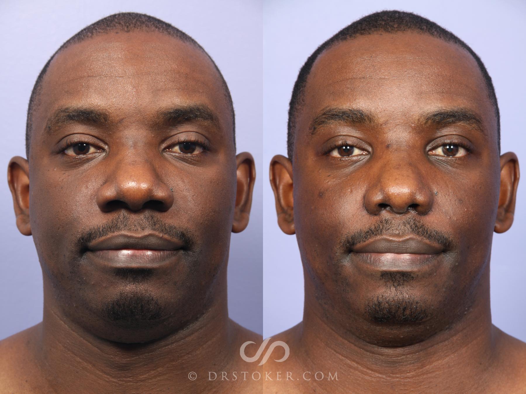Before & After Rhinoplasty Case 522 View #1 View in Los Angeles, CA