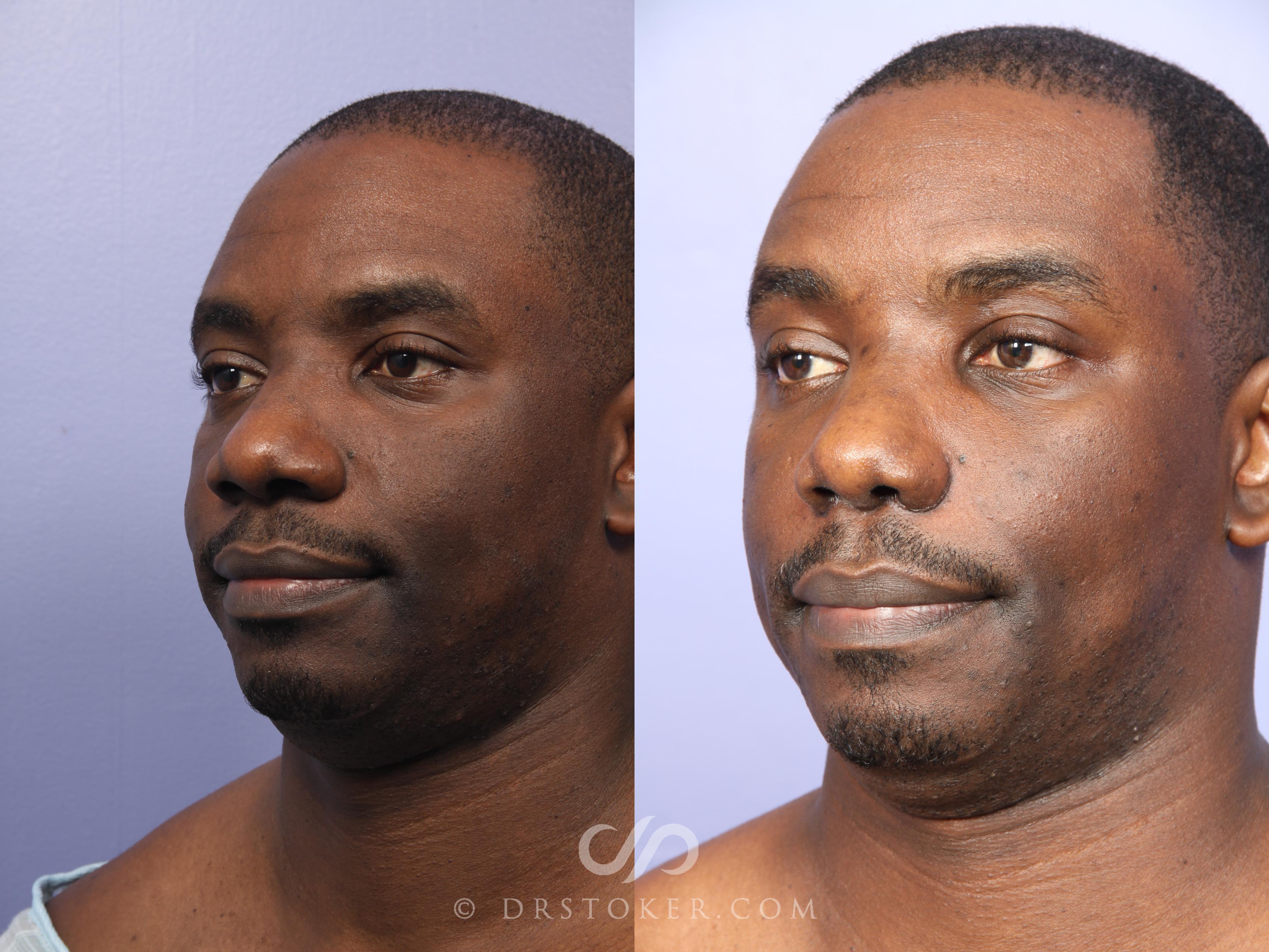 Before & After Rhinoplasty Case 522 View #3 View in Los Angeles, CA