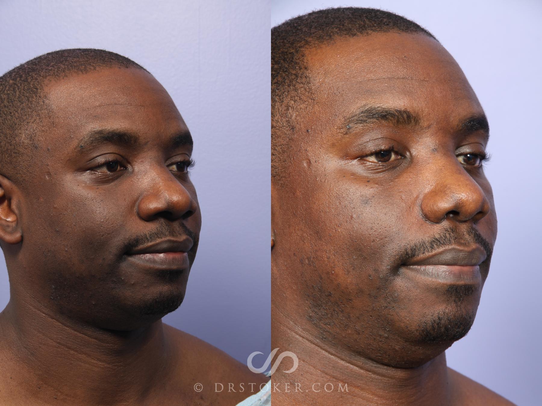 Before & After Rhinoplasty Case 522 View #4 View in Los Angeles, CA
