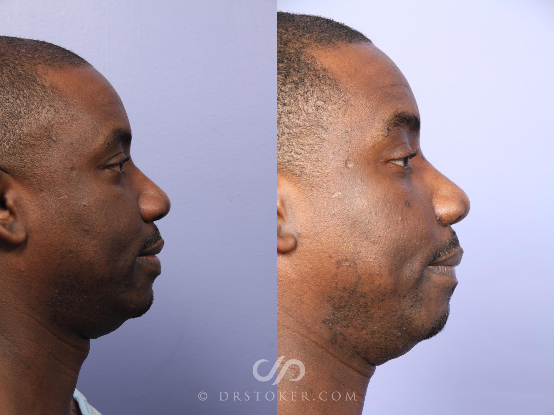 Before & After Rhinoplasty Case 522 View #5 View in Los Angeles, CA