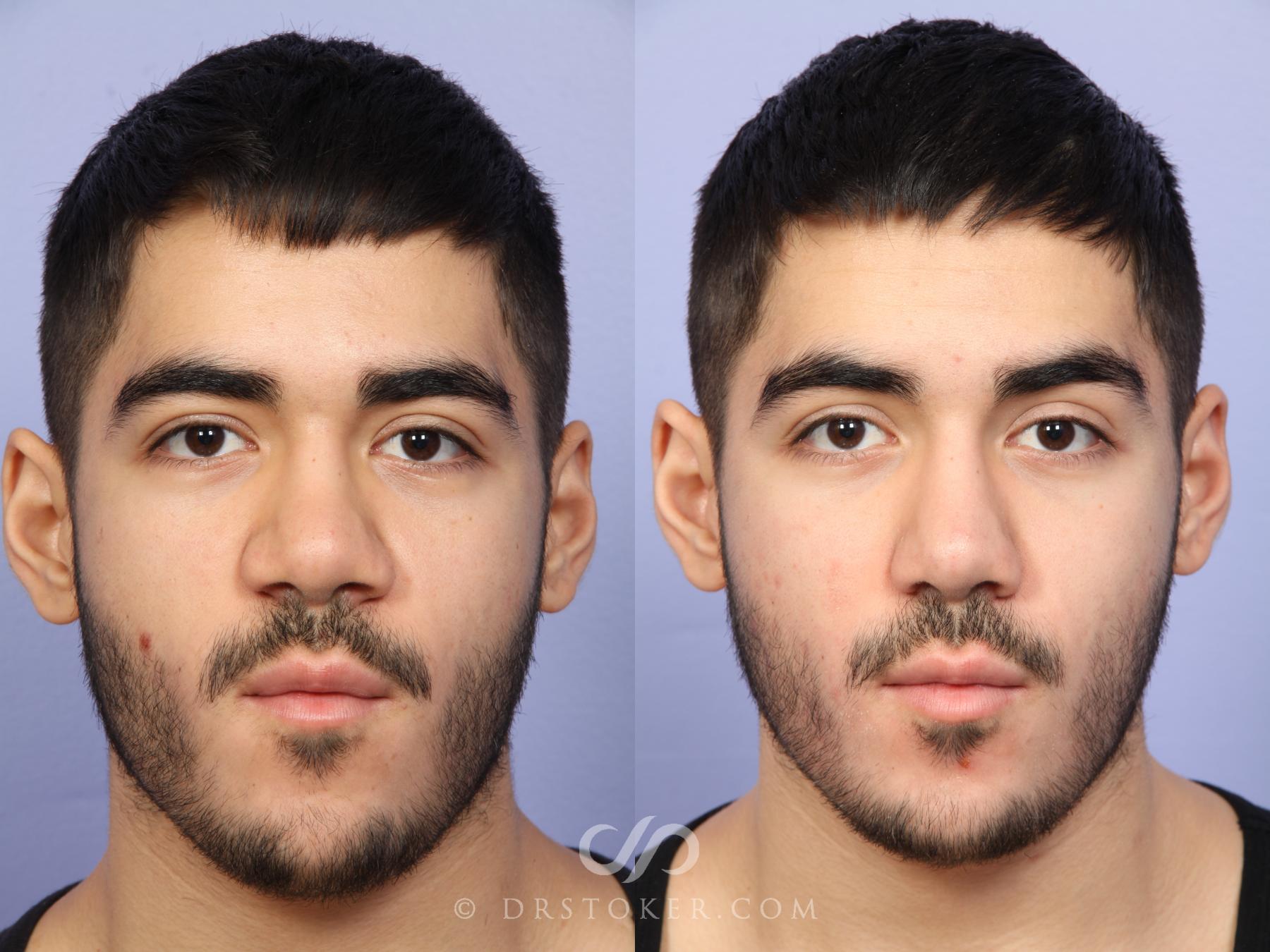 Before & After Rhinoplasty Case 523 View #1 View in Los Angeles, CA