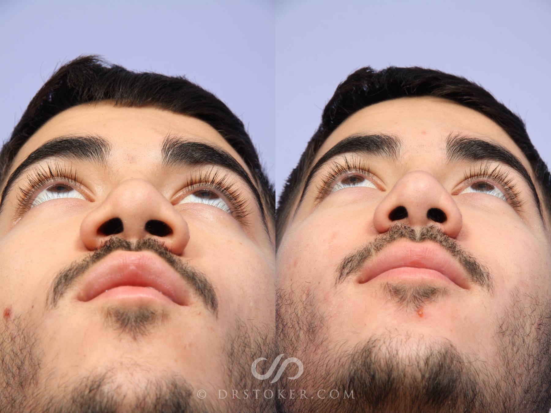 Before & After Rhinoplasty Case 523 View #3 View in Los Angeles, CA