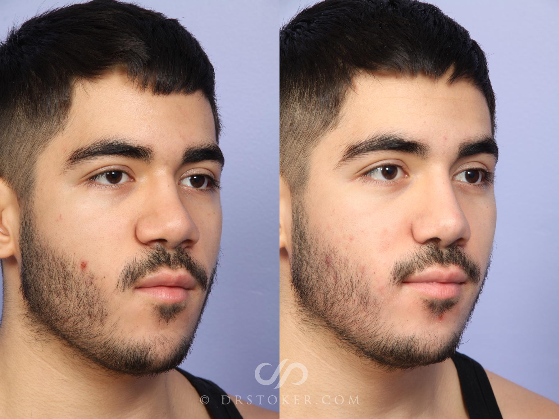 Before & After Rhinoplasty Case 523 View #4 View in Los Angeles, CA