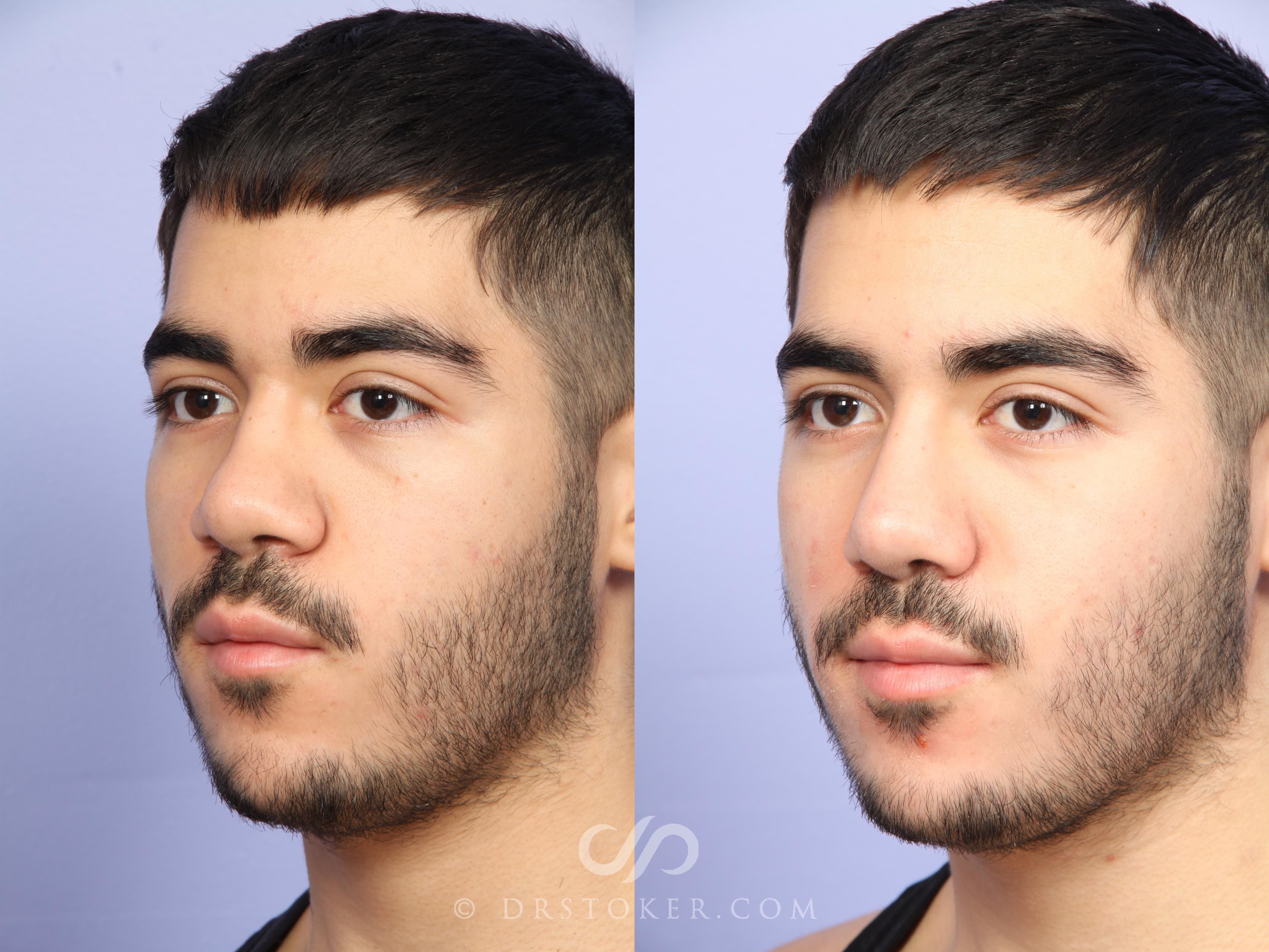 Before & After Rhinoplasty Case 523 View #5 View in Los Angeles, CA