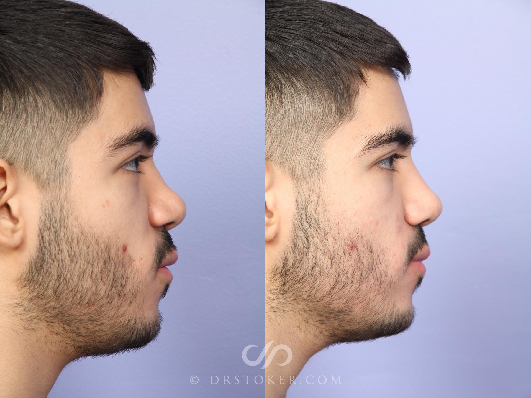 Before & After Rhinoplasty Case 523 View #6 View in Los Angeles, CA