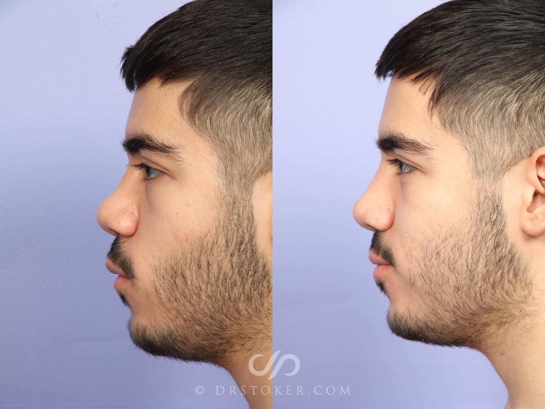 Before & After Rhinoplasty Case 523 View #7 View in Los Angeles, CA