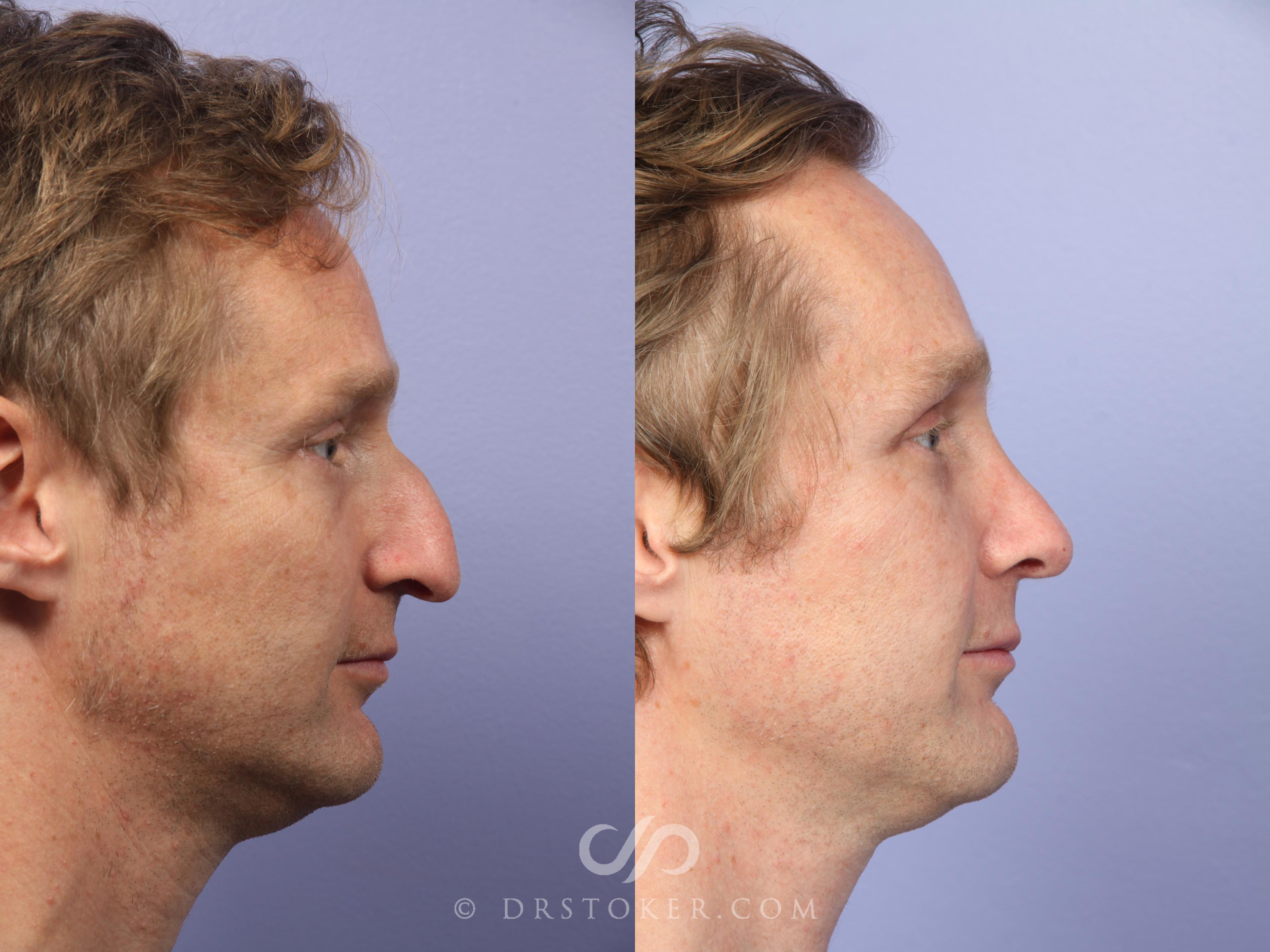 Before & After Rhinoplasty Case 524 View #3 View in Marina del Rey, CA