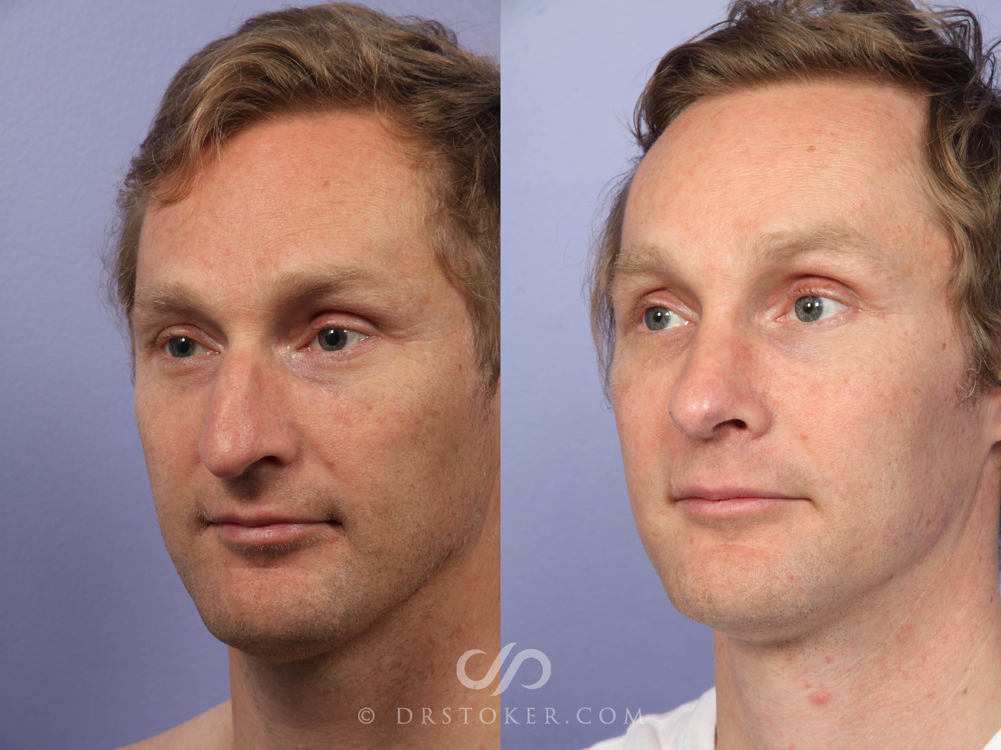 Before & After Rhinoplasty Case 524 View #4 View in Marina del Rey, CA