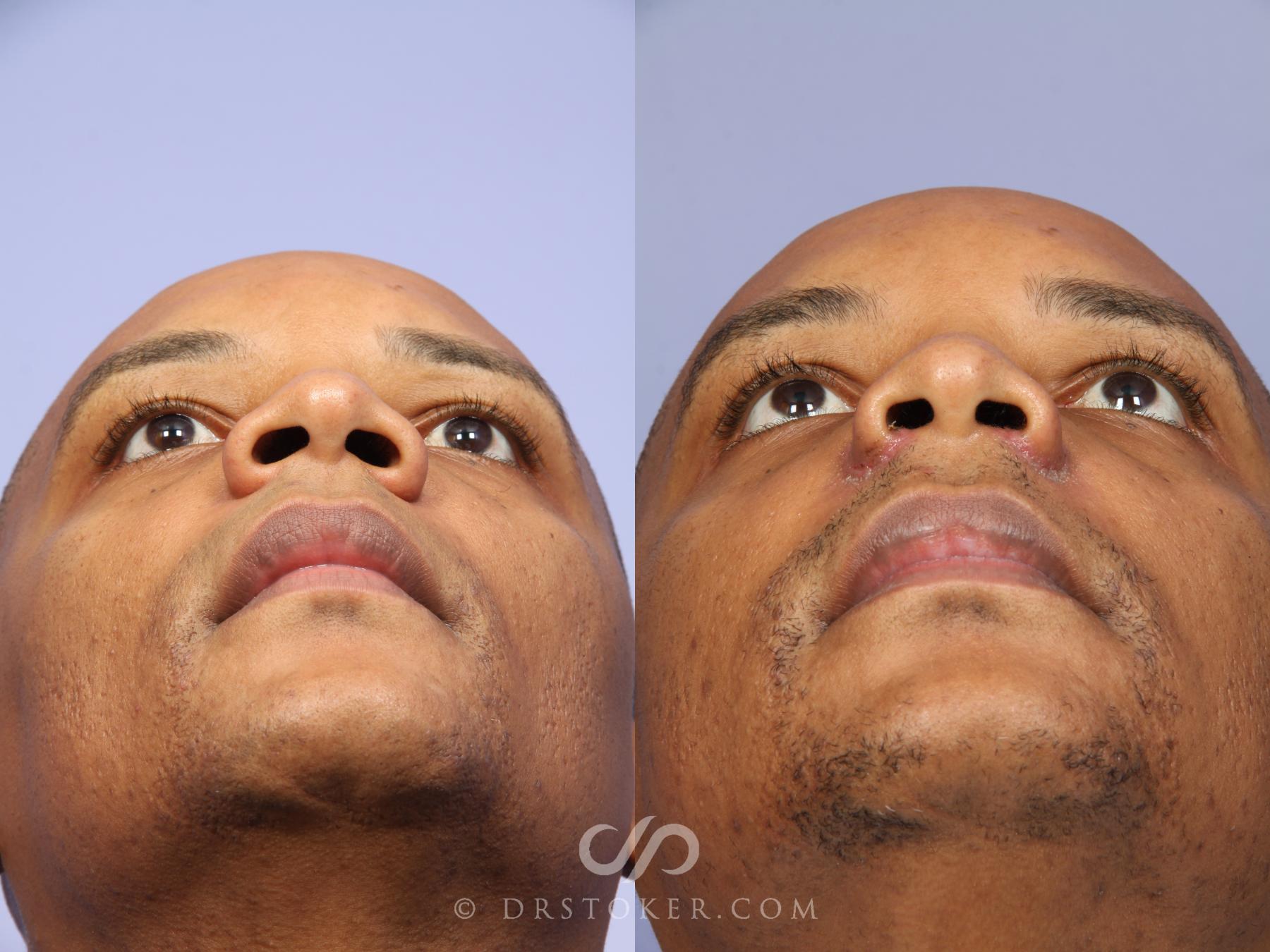 Before & After Rhinoplasty Case 525 View #2 View in Los Angeles, CA