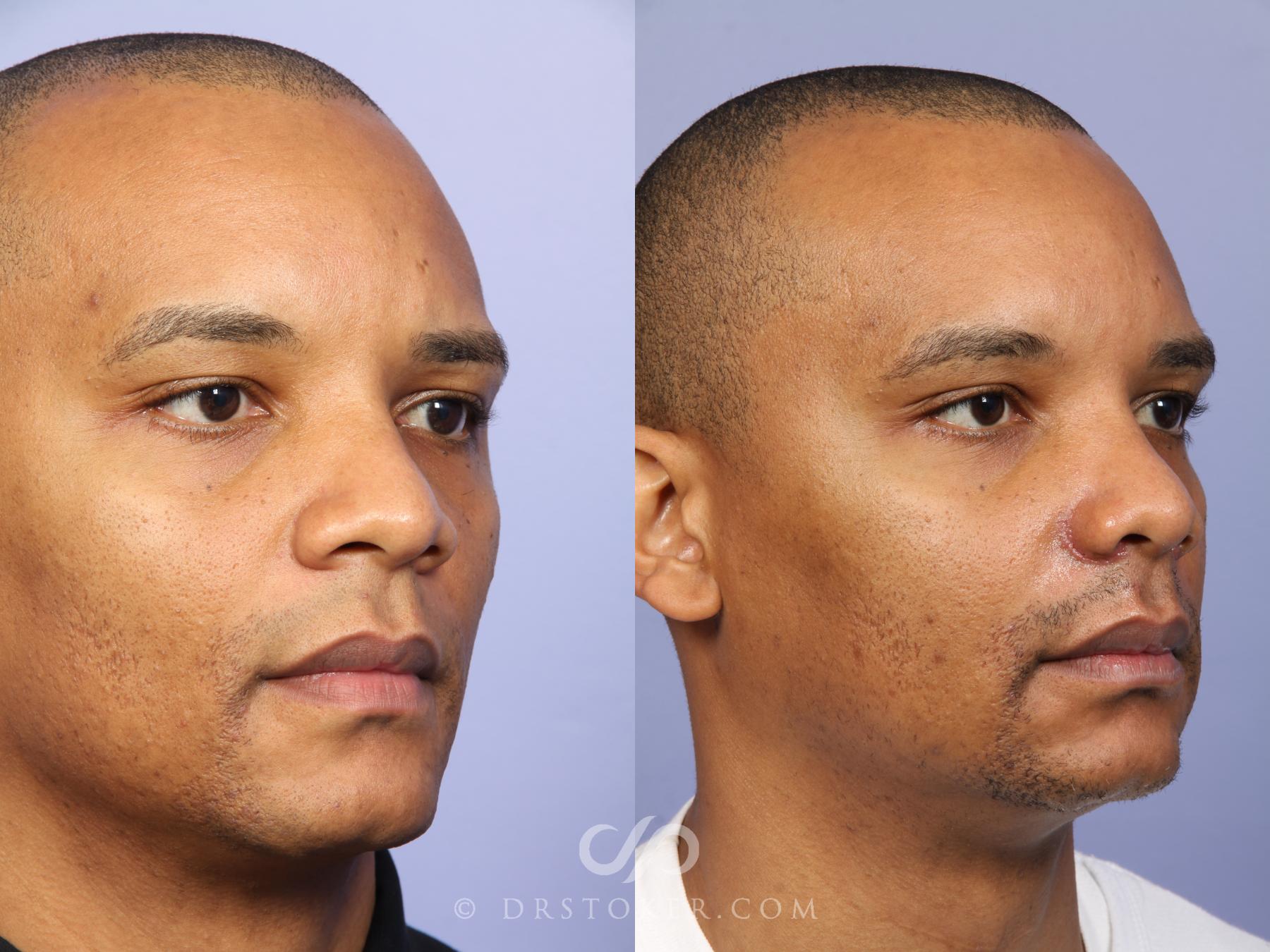 Before & After Rhinoplasty Case 525 View #3 View in Los Angeles, CA
