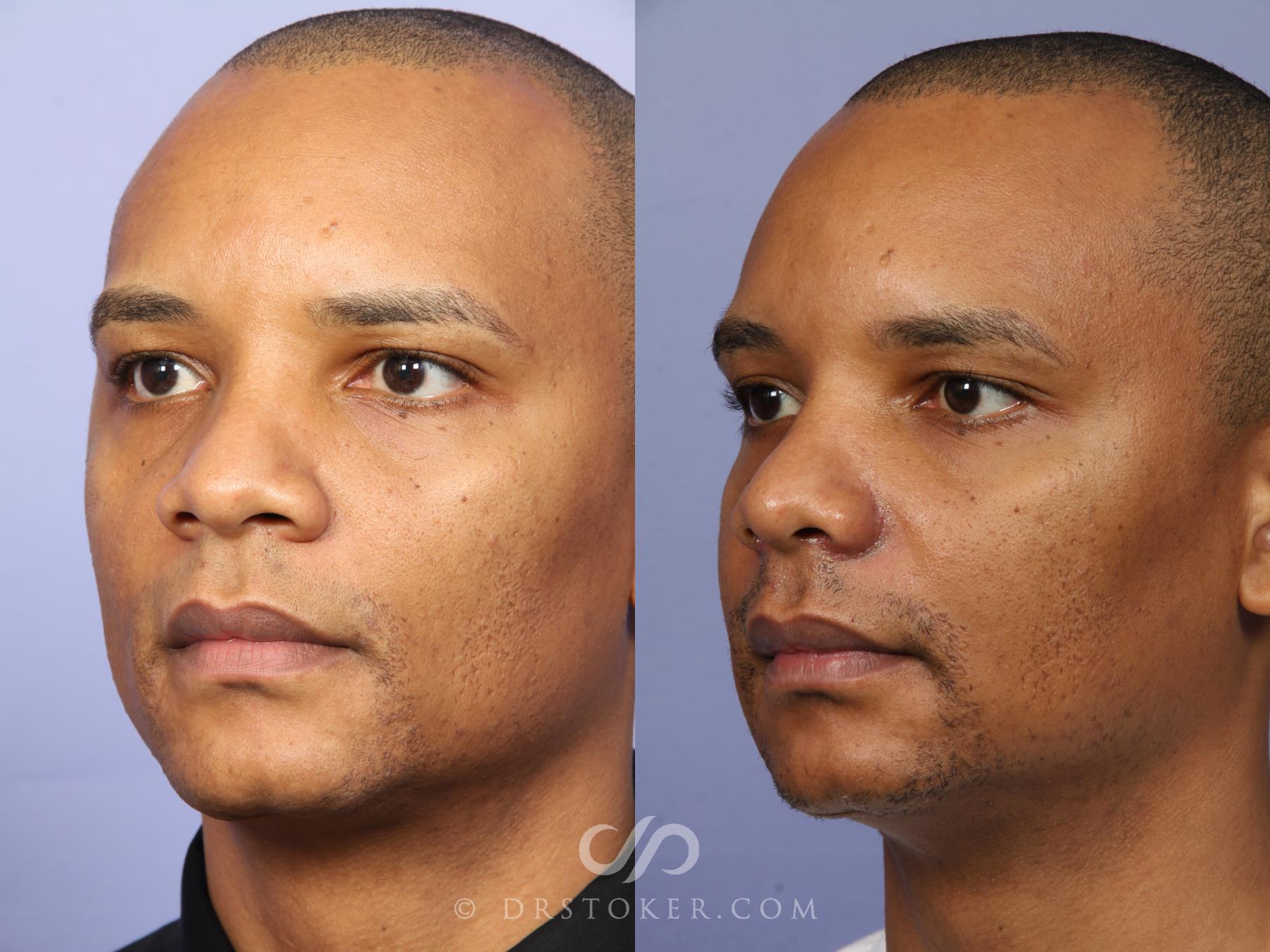 Before & After Rhinoplasty Case 525 View #4 View in Los Angeles, CA