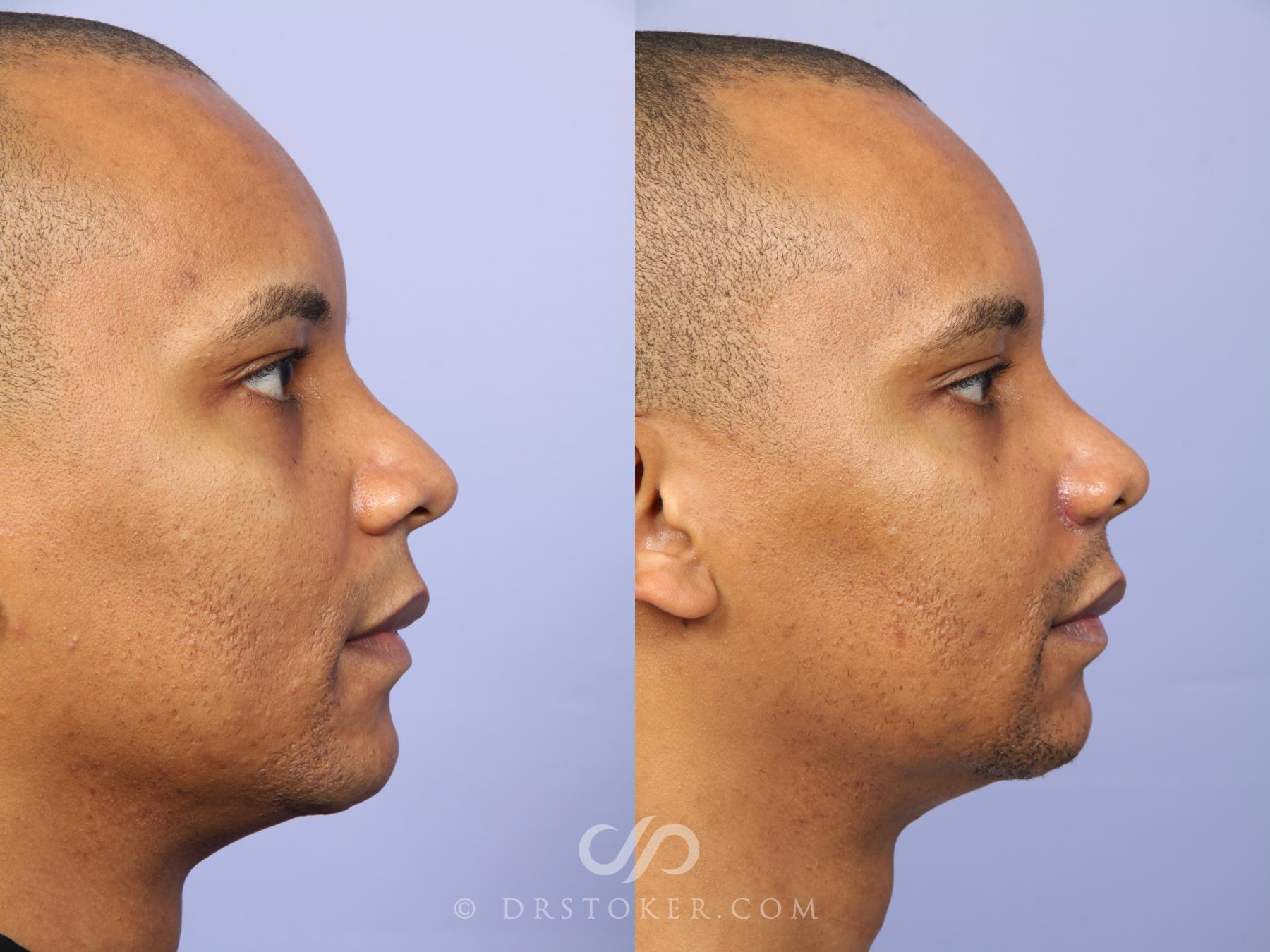 Before & After Rhinoplasty Case 525 View #5 View in Los Angeles, CA