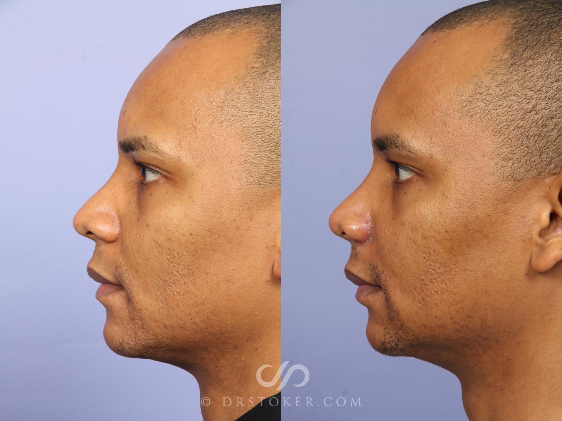 Before & After Rhinoplasty Case 525 View #6 View in Los Angeles, CA