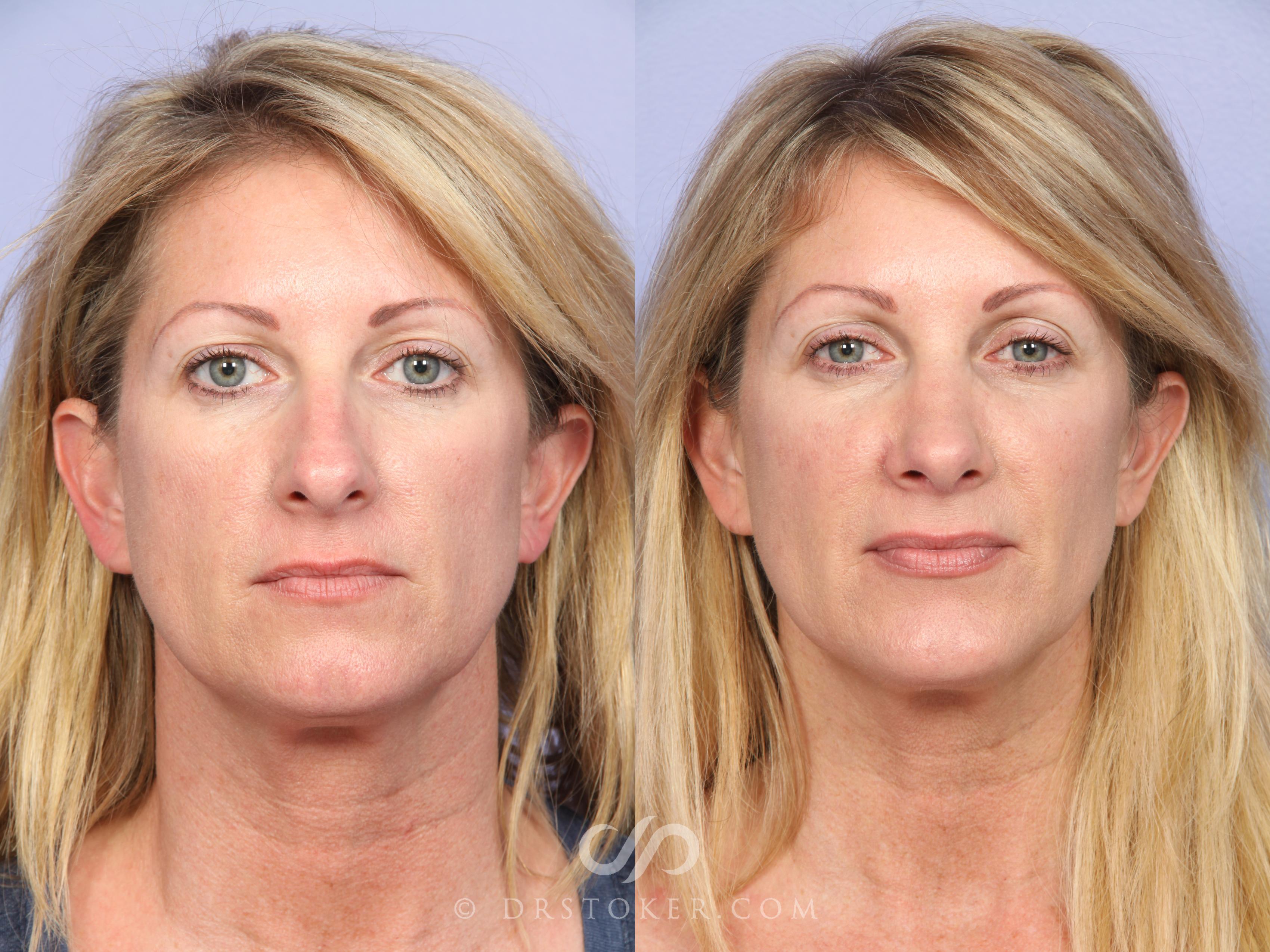 Before & After Rhinoplasty Case 526 View #1 View in Los Angeles, CA