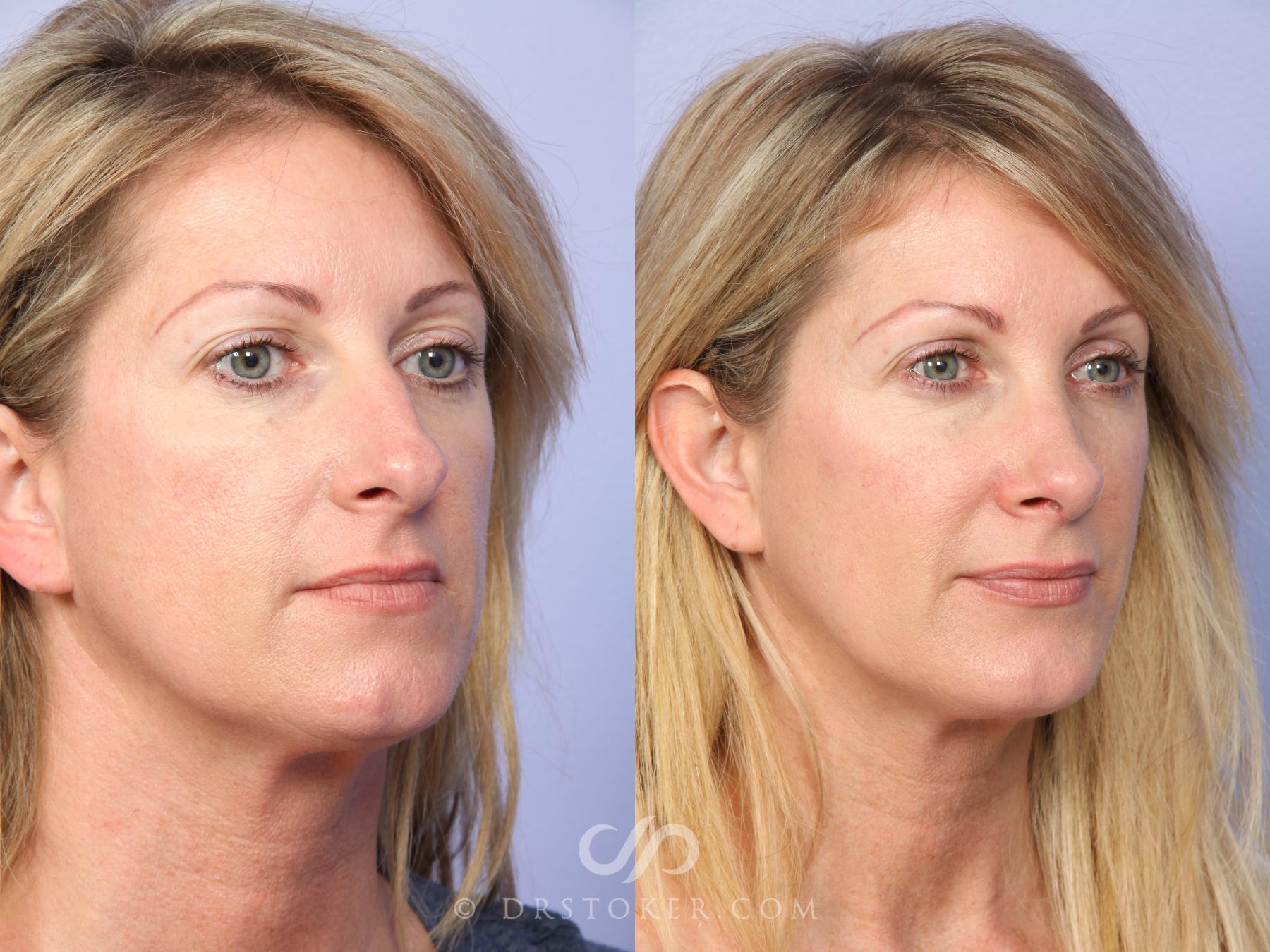 Before & After Cheek/Chin Contouring Case 526 View #2 View in Los Angeles, CA