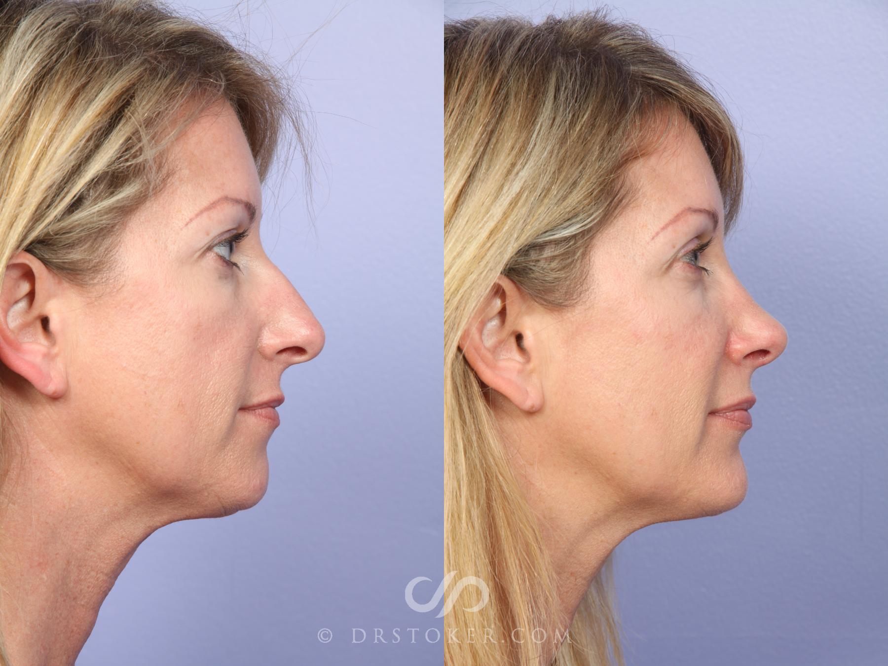 Before & After Rhinoplasty Case 526 View #3 View in Los Angeles, CA