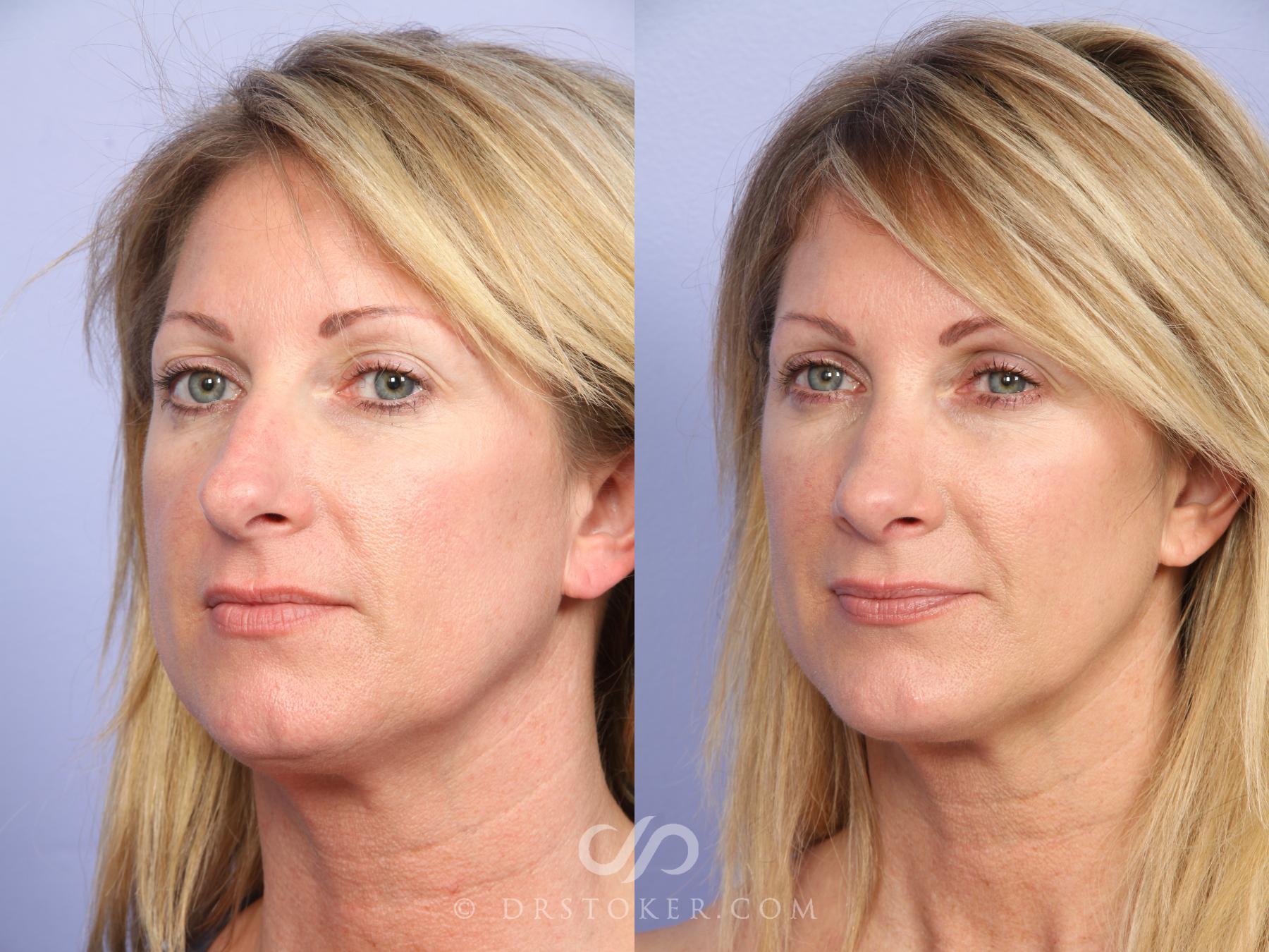 Before & After Rhinoplasty Case 526 View #4 View in Los Angeles, CA