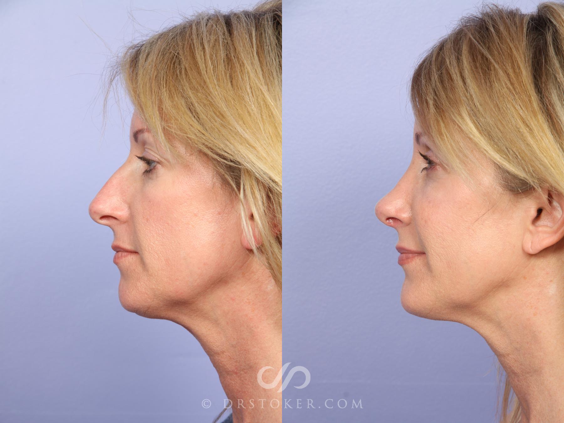 Before & After Cheek/Chin Contouring Case 526 View #5 View in Los Angeles, CA
