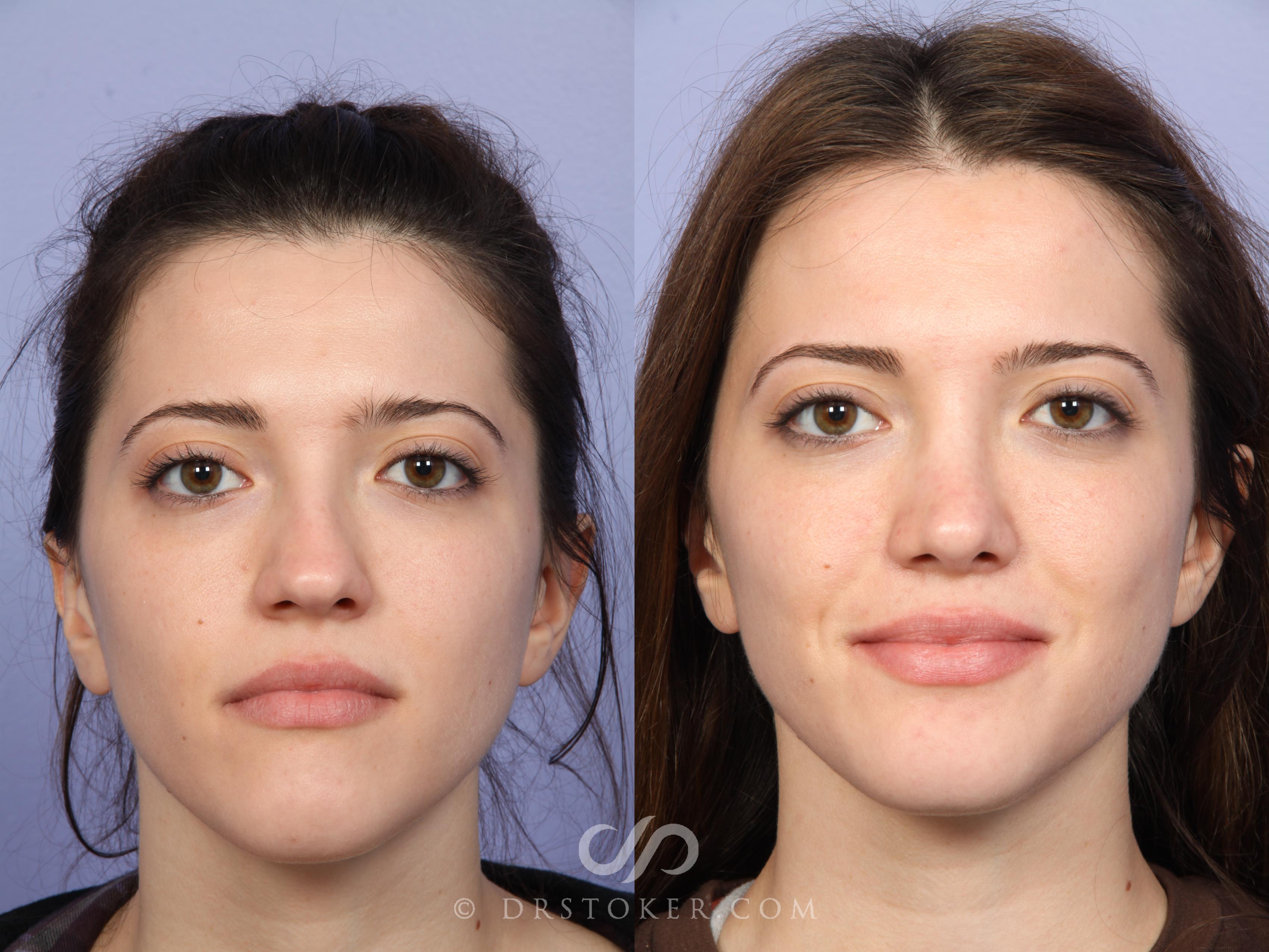 Before & After Rhinoplasty Case 527 View #1 View in Los Angeles, CA