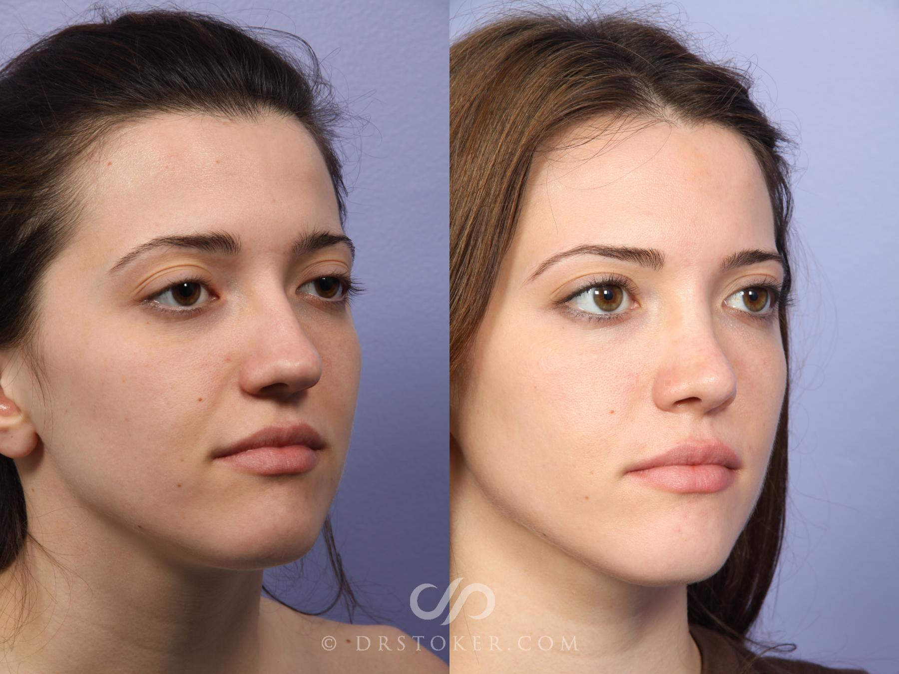 Before & After Rhinoplasty Case 527 View #2 View in Los Angeles, CA