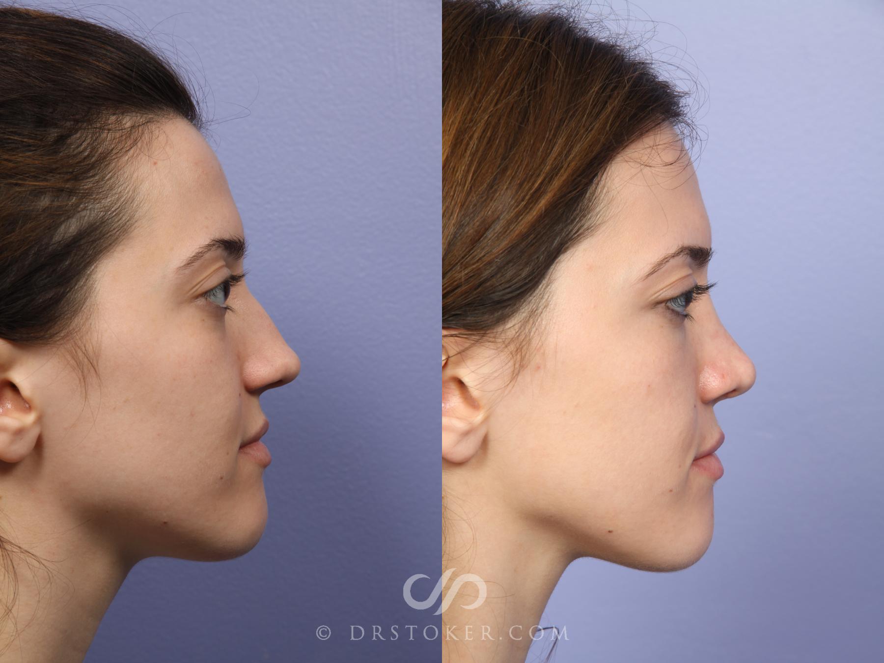 Before & After Rhinoplasty Case 527 View #3 View in Los Angeles, CA