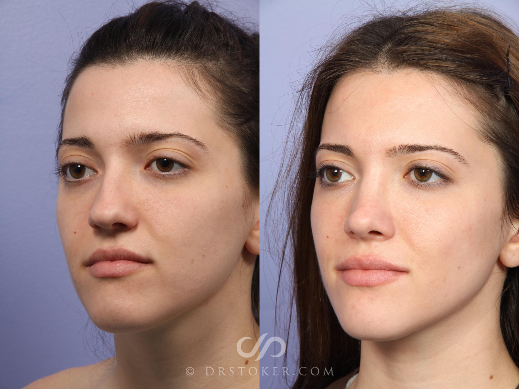 Before & After Rhinoplasty Case 527 View #4 View in Los Angeles, CA
