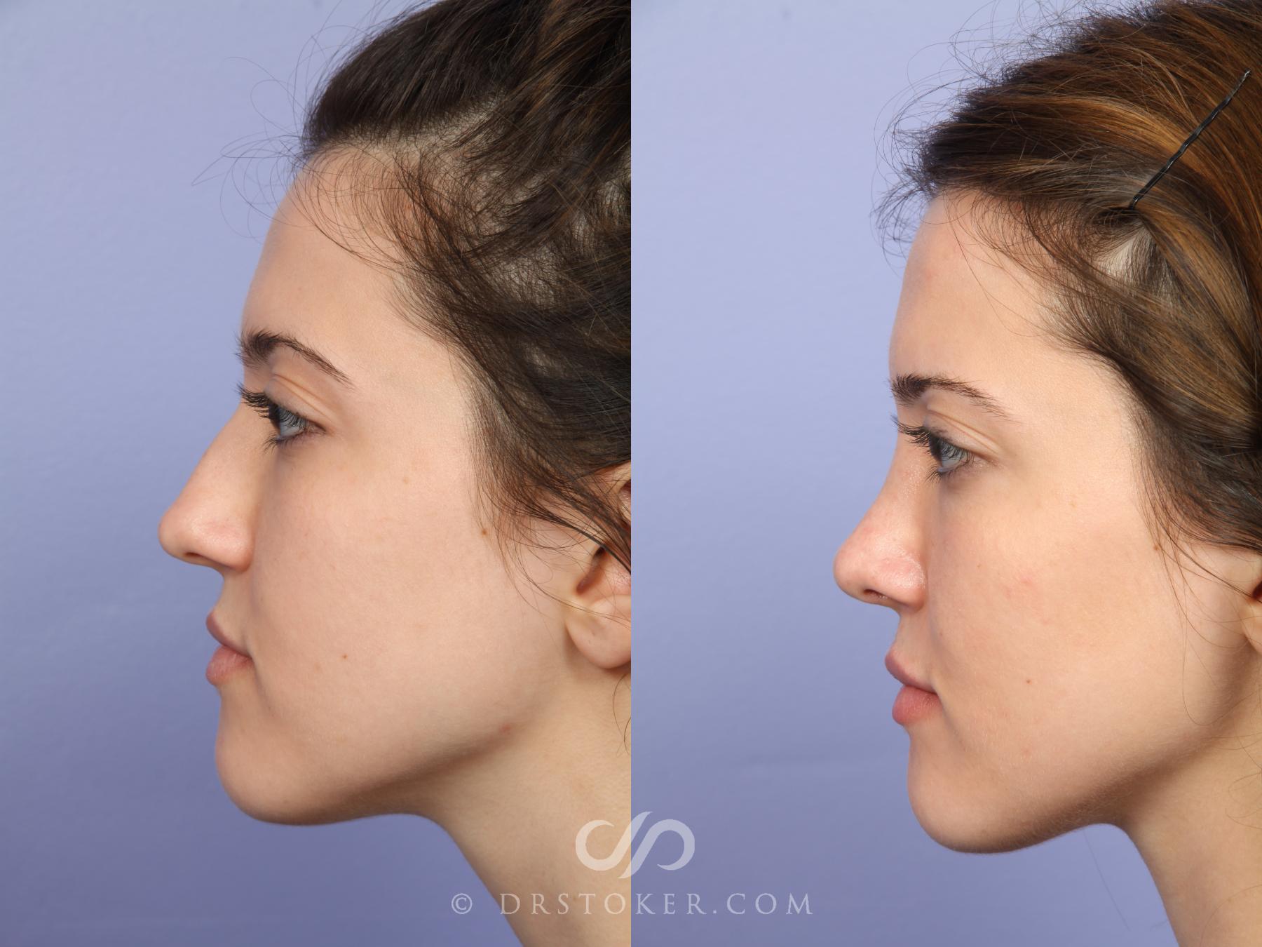 Before & After Rhinoplasty Case 527 View #5 View in Los Angeles, CA