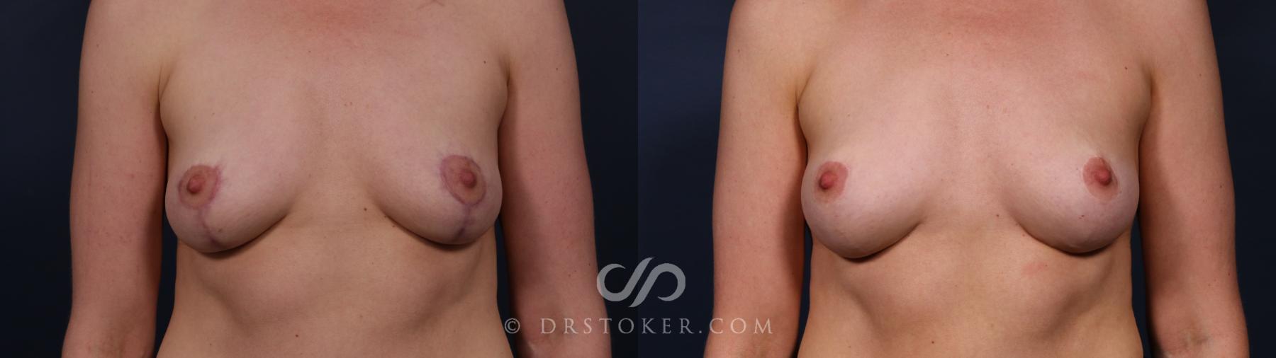 Before & After Scar Camouflage  Case 2587 Front View in Los Angeles, CA