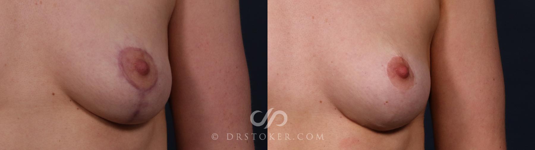 Before & After Scar Camouflage  Case 2588 Front View in Los Angeles, CA