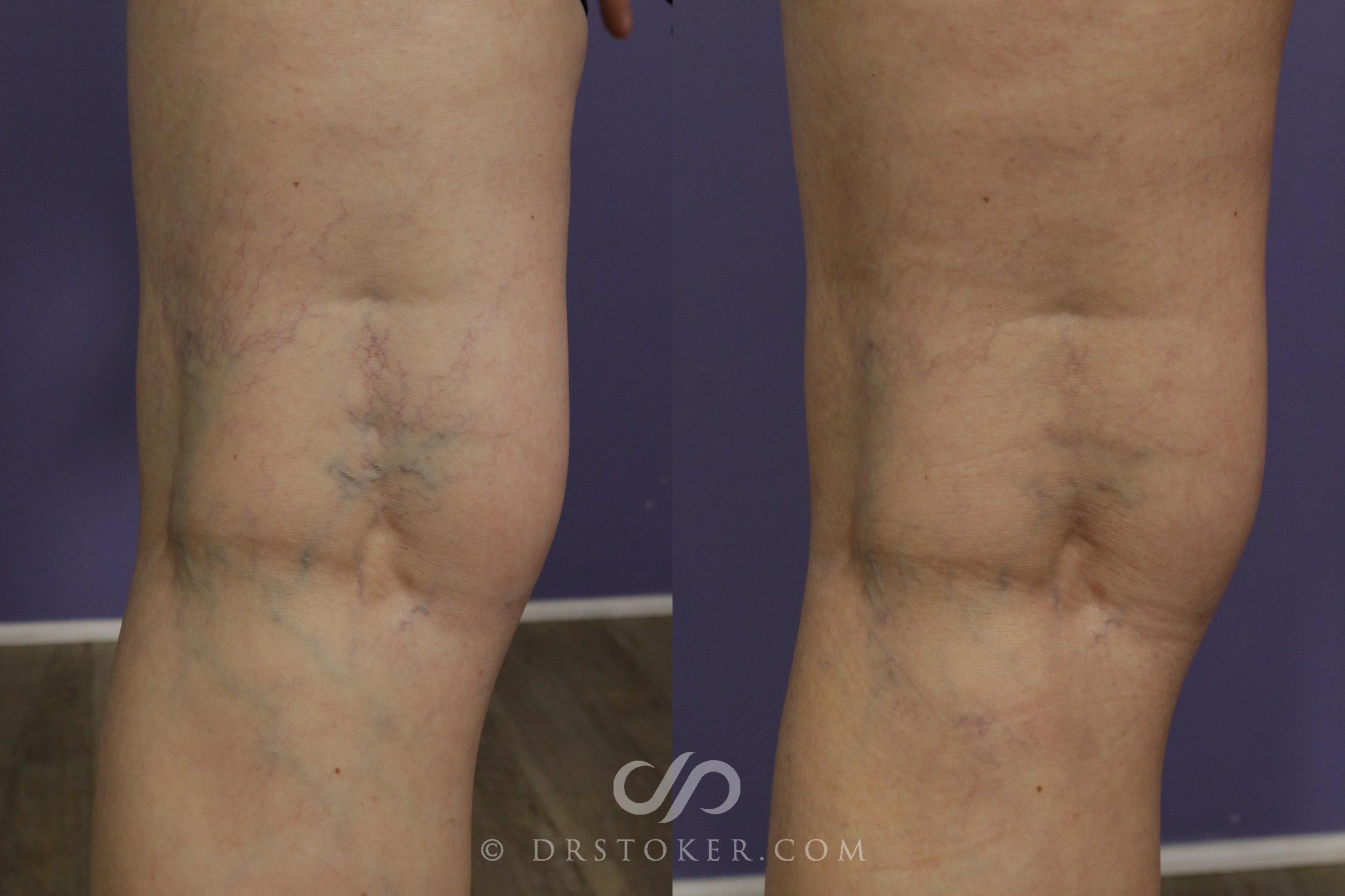 Before & After Sclerotherapy Vein Treatment Case 1657 View #1 View in Marina del Rey, CA