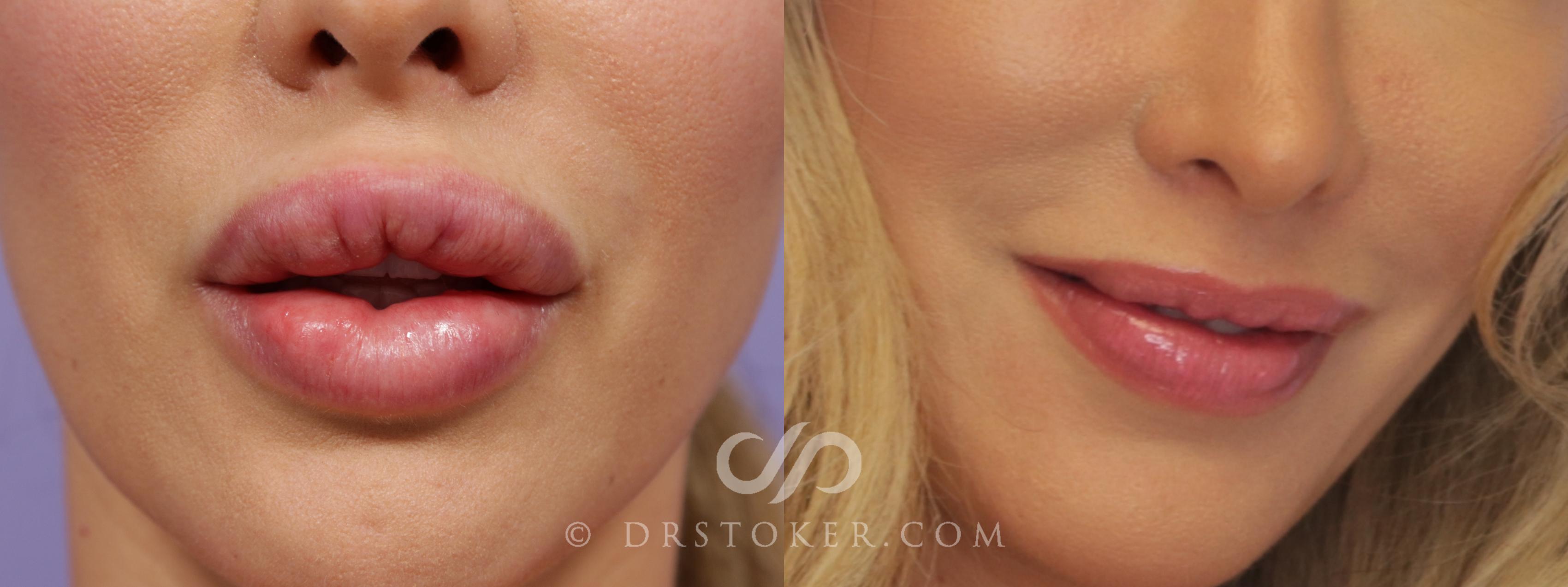 Before & After Silicone Lip Removal Case 2068 Front View in Los Angeles, CA