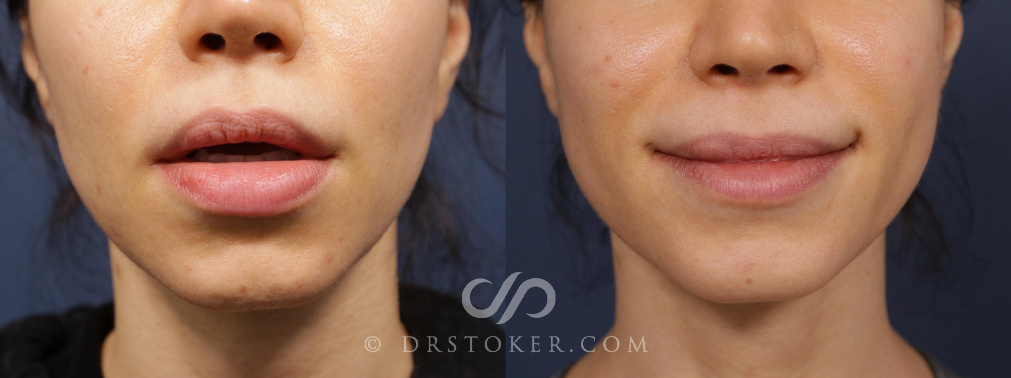 Before & After Silicone Lip Removal Case 2069 Front View in Los Angeles, CA