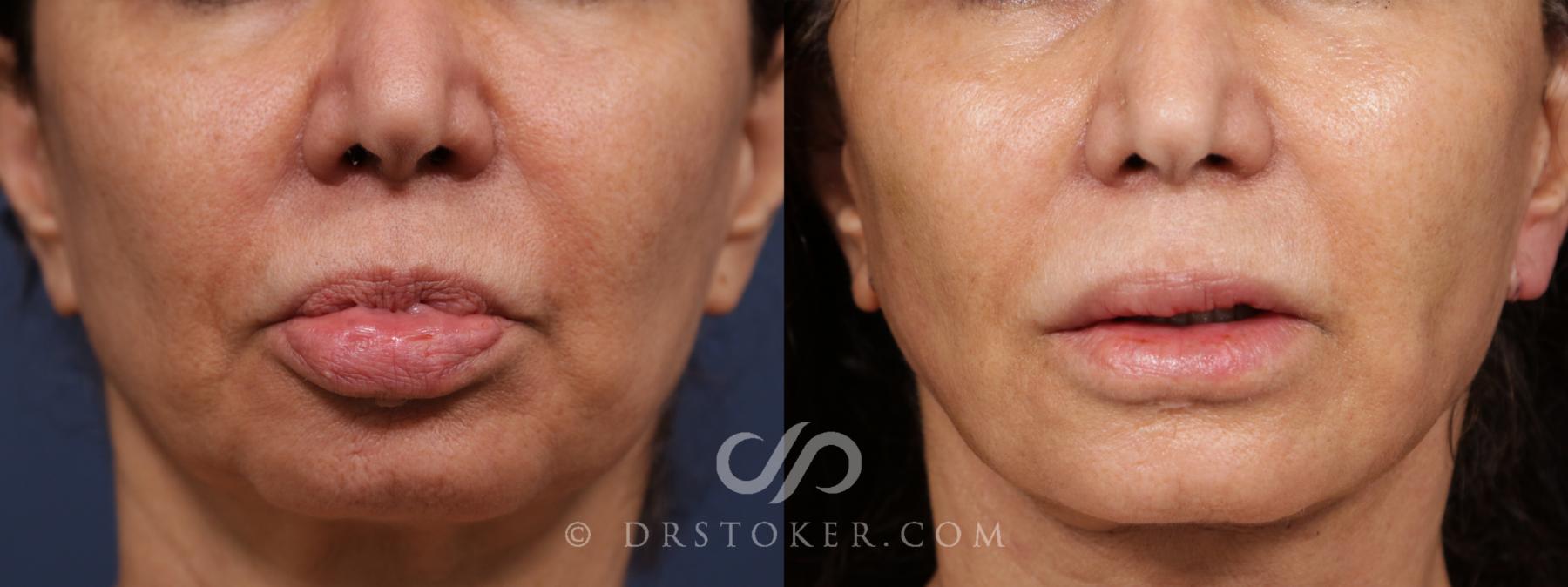 Before & After Silicone Lip Removal Case 2073 Front View in Los Angeles, CA