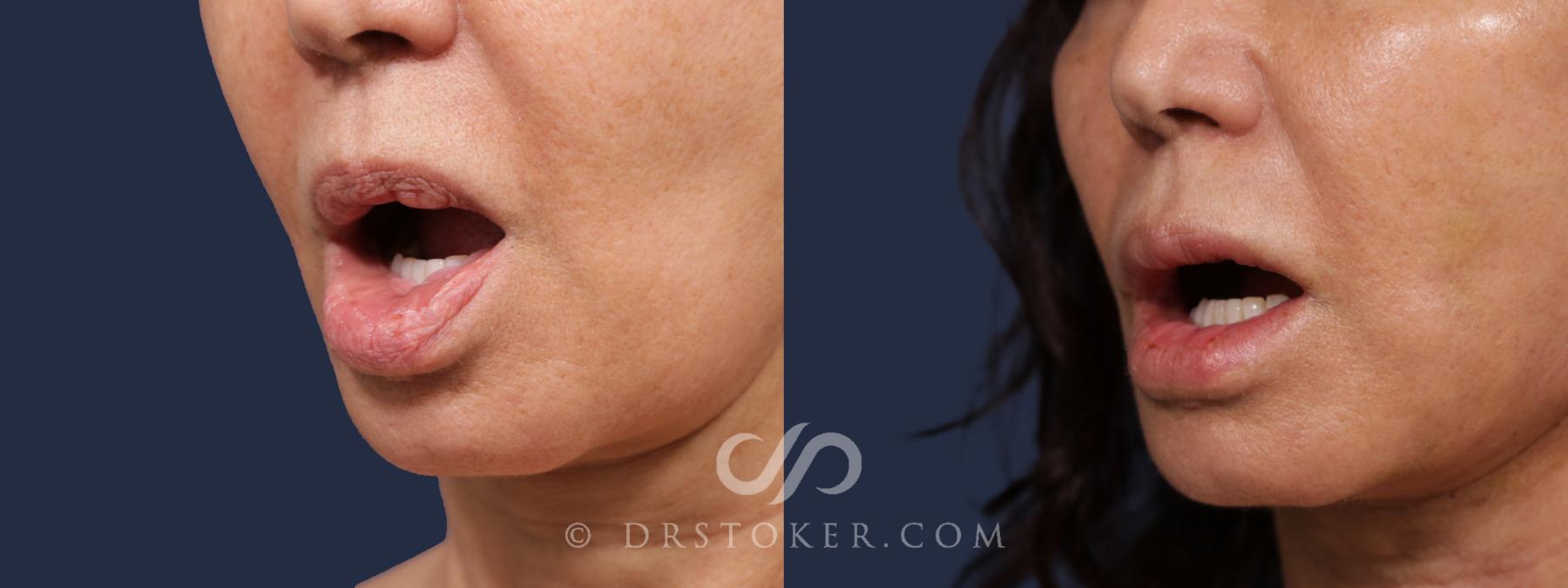 Before & After Silicone Lip Removal Case 2073 Left Oblique View in Los Angeles, CA