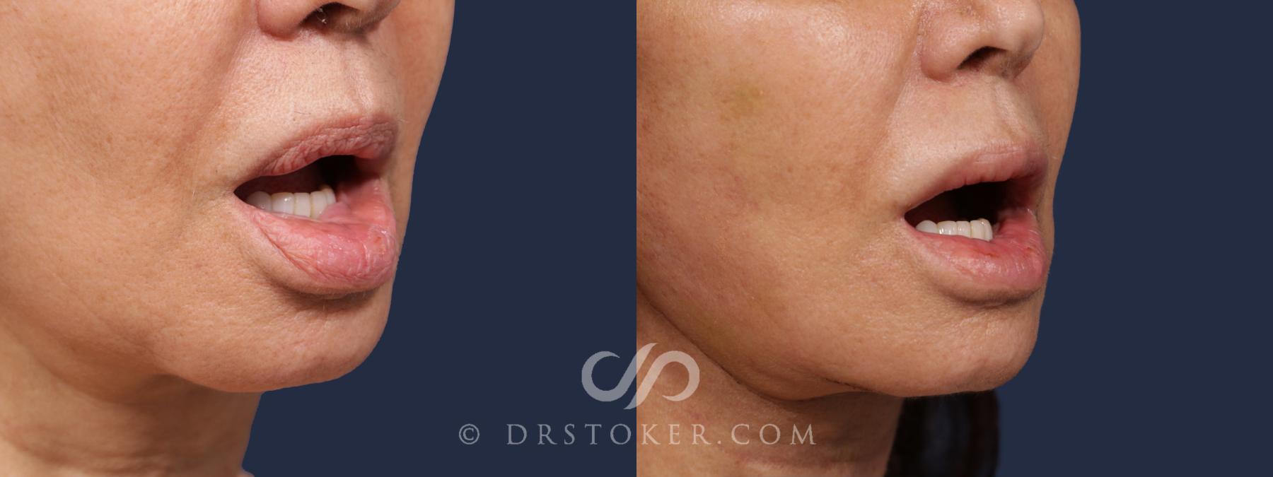 Before & After Silicone Lip Removal Case 2073 Right Oblique View in Los Angeles, CA