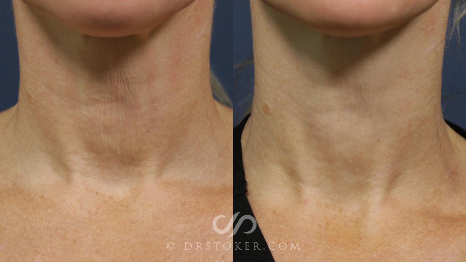 Before & After Skin Rejuvenation Treatments Case 2266 Front View in Los Angeles, CA