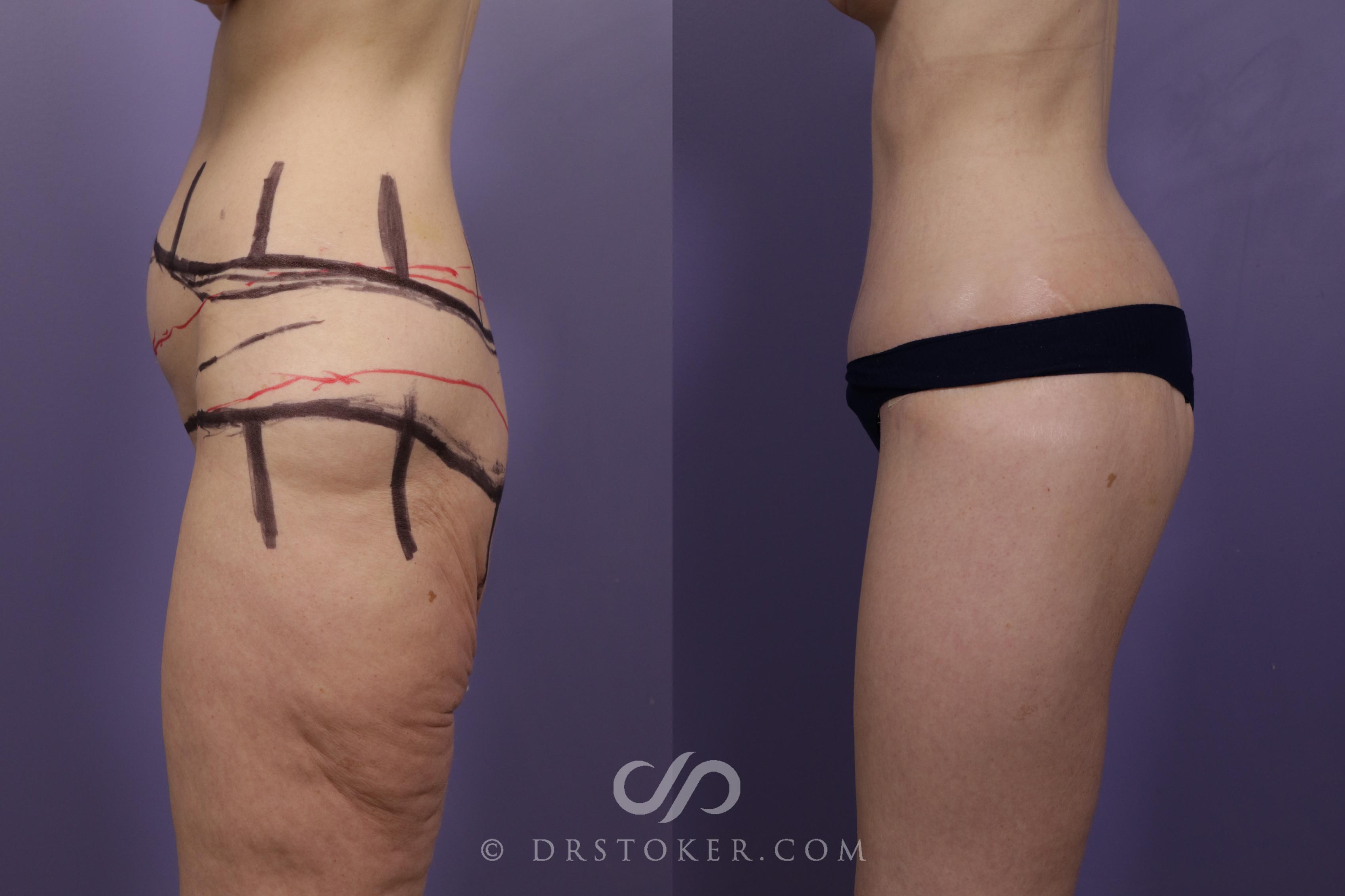 Before & After Thigh lift Case 1681 View #1 View in Marina del Rey, CA