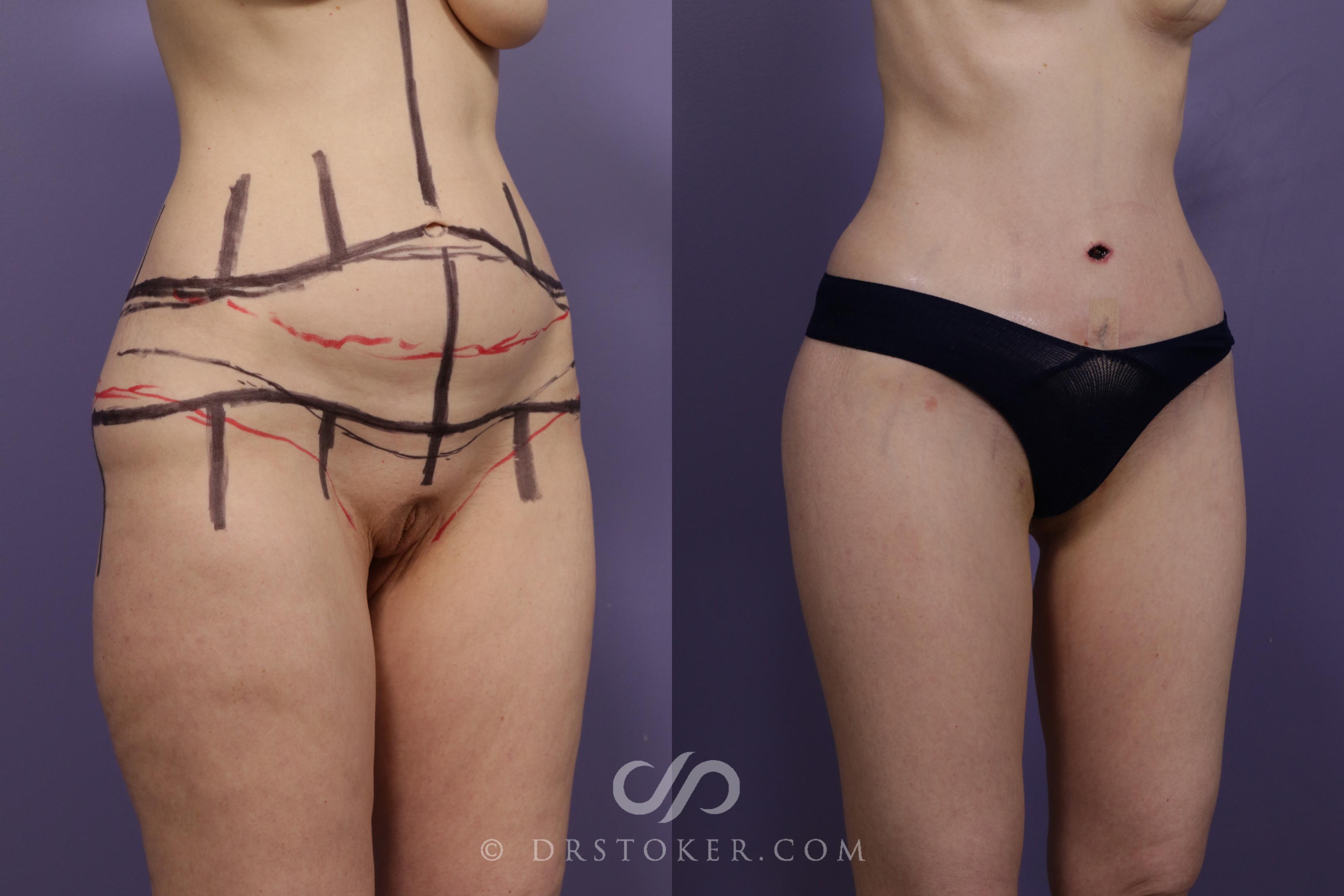 Before & After Tummy Tuck Case 1682 View #1 View in Los Angeles, CA