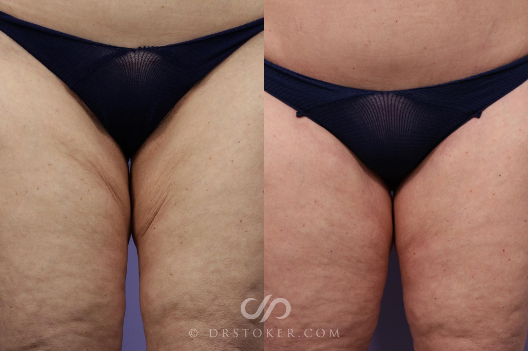 Before & After Thigh lift Case 1686 View #1 View in Los Angeles, CA