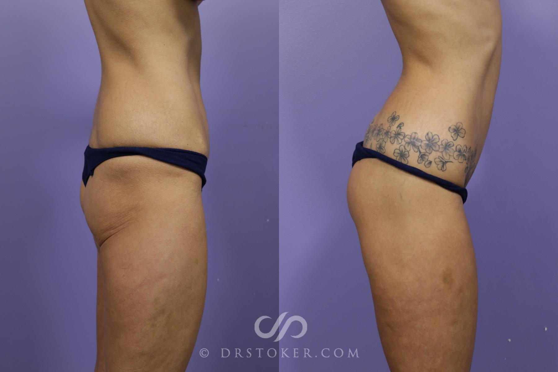 Before & After Body Lift Case 1689 View #1 View in Los Angeles, CA