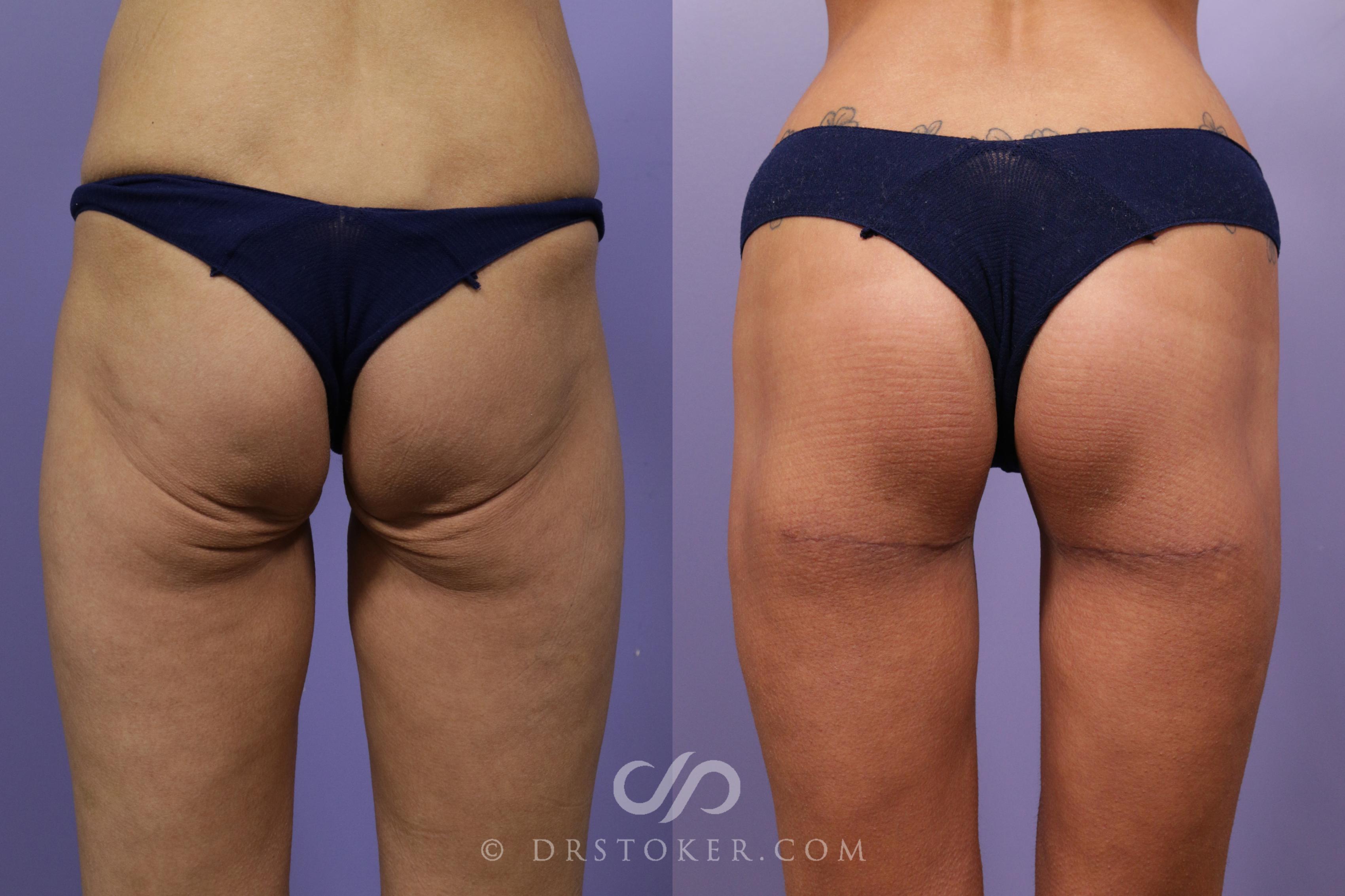 Before & After Thigh lift Case 1692 View #1 View in Los Angeles, CA