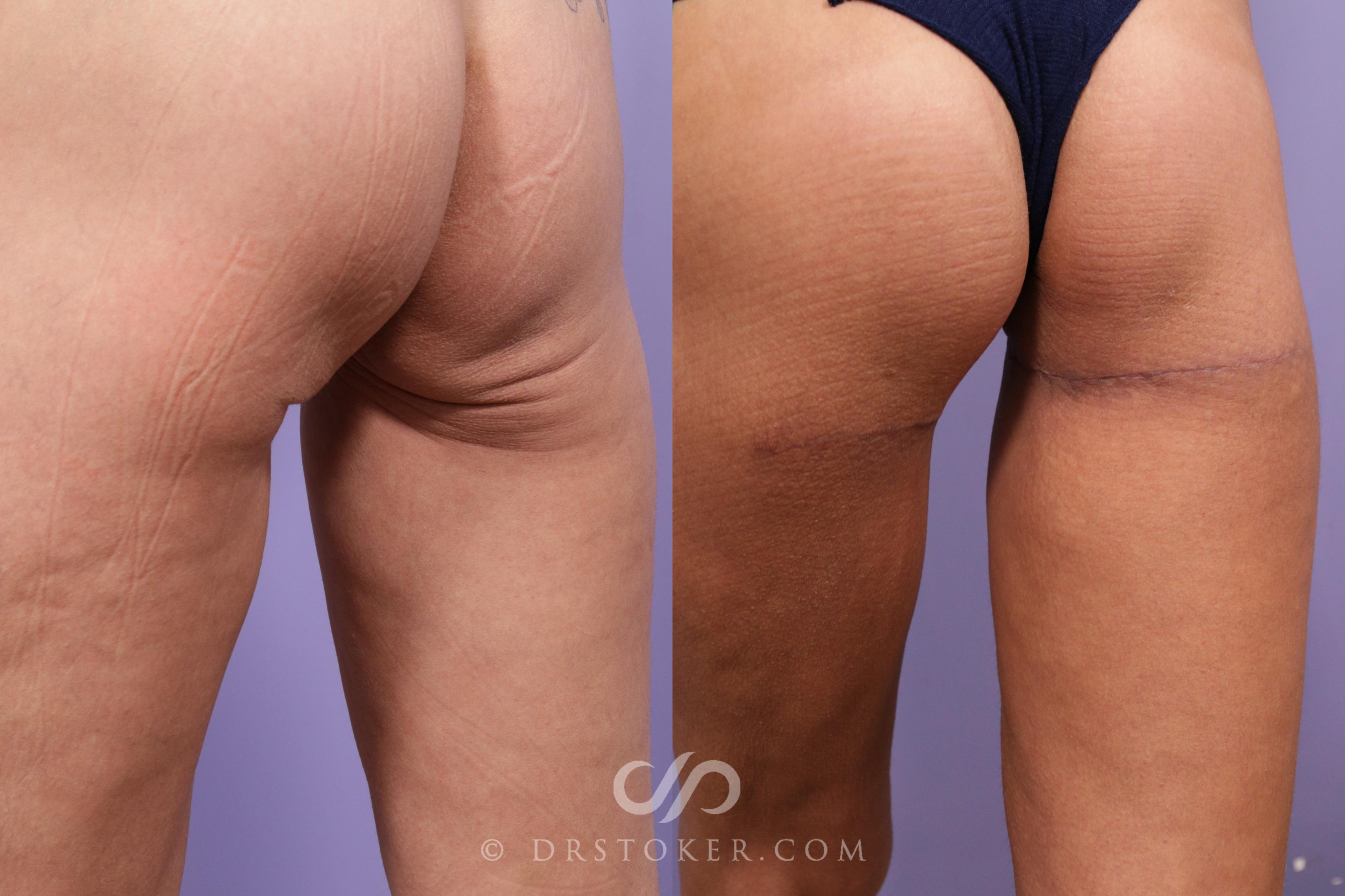 Before & After Body Lift Case 1693 View #1 View in Los Angeles, CA