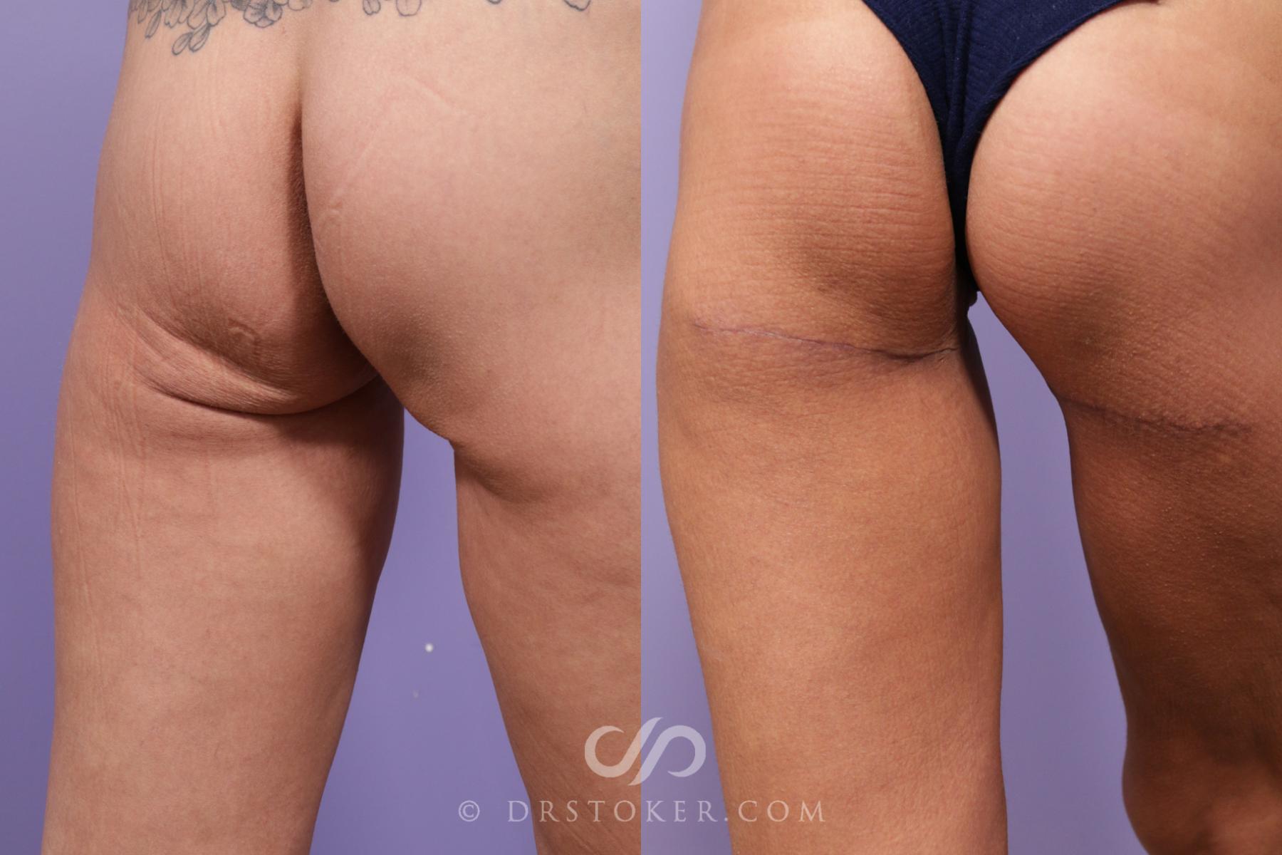 Before & After Body Lift Case 1694 View #1 View in Los Angeles, CA