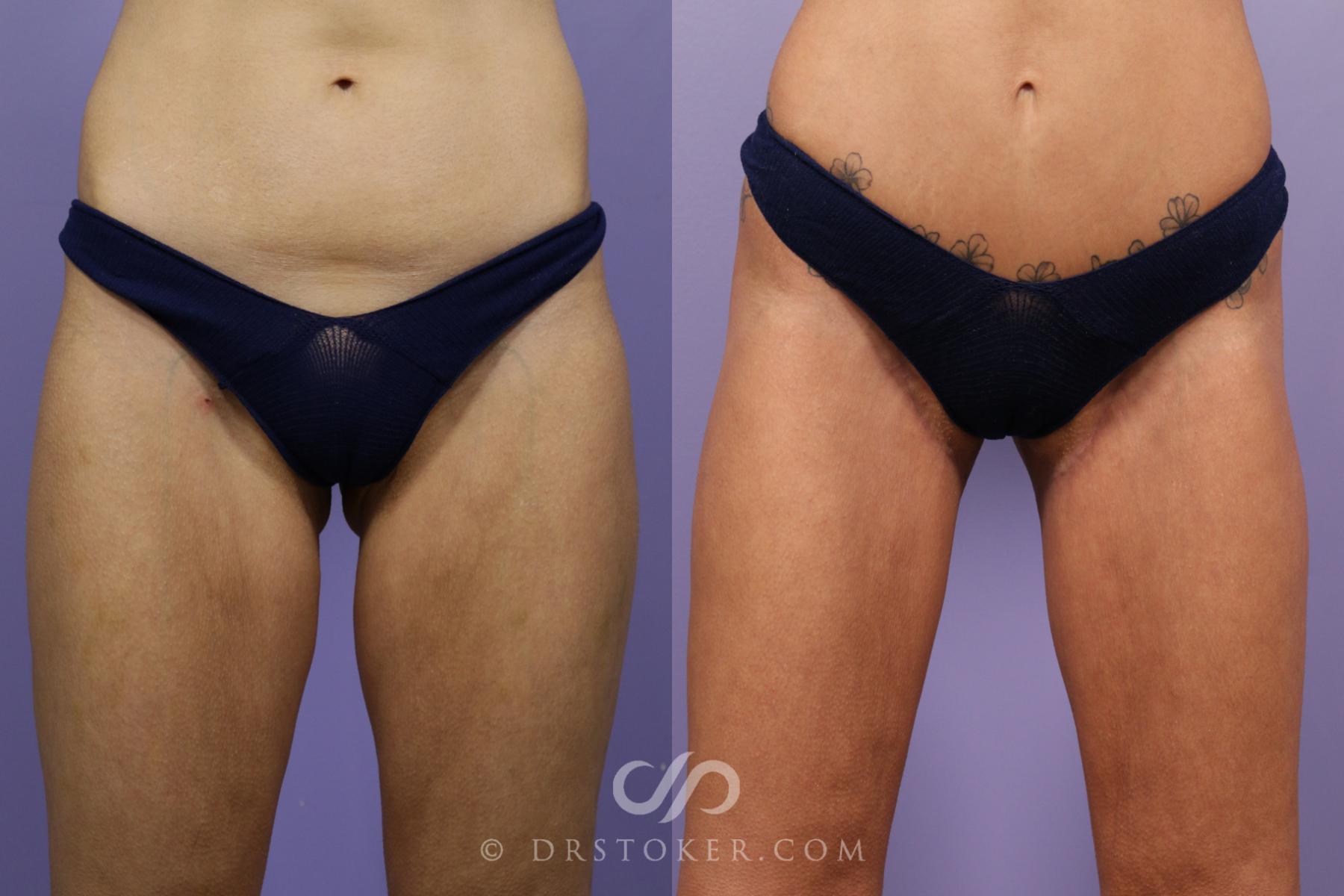 Before & After Thigh lift Case 1696 View #1 View in Los Angeles, CA