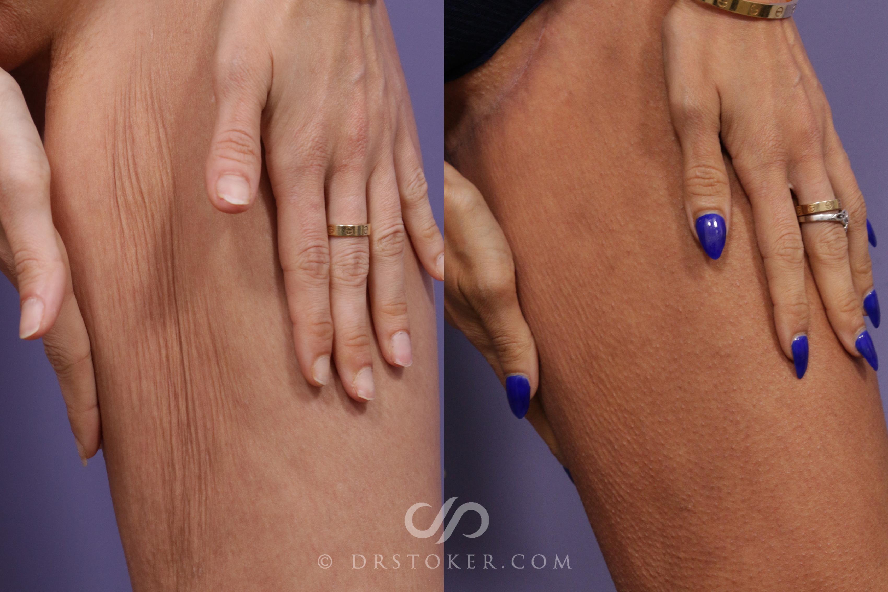 Before & After Thigh lift Case 1697 View #1 View in Los Angeles, CA