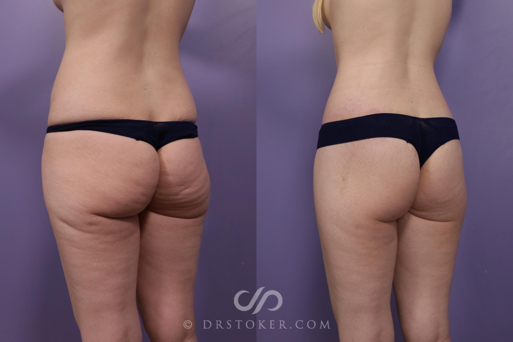 Before & After Thigh lift Case 1709 View #1 View in Los Angeles, CA