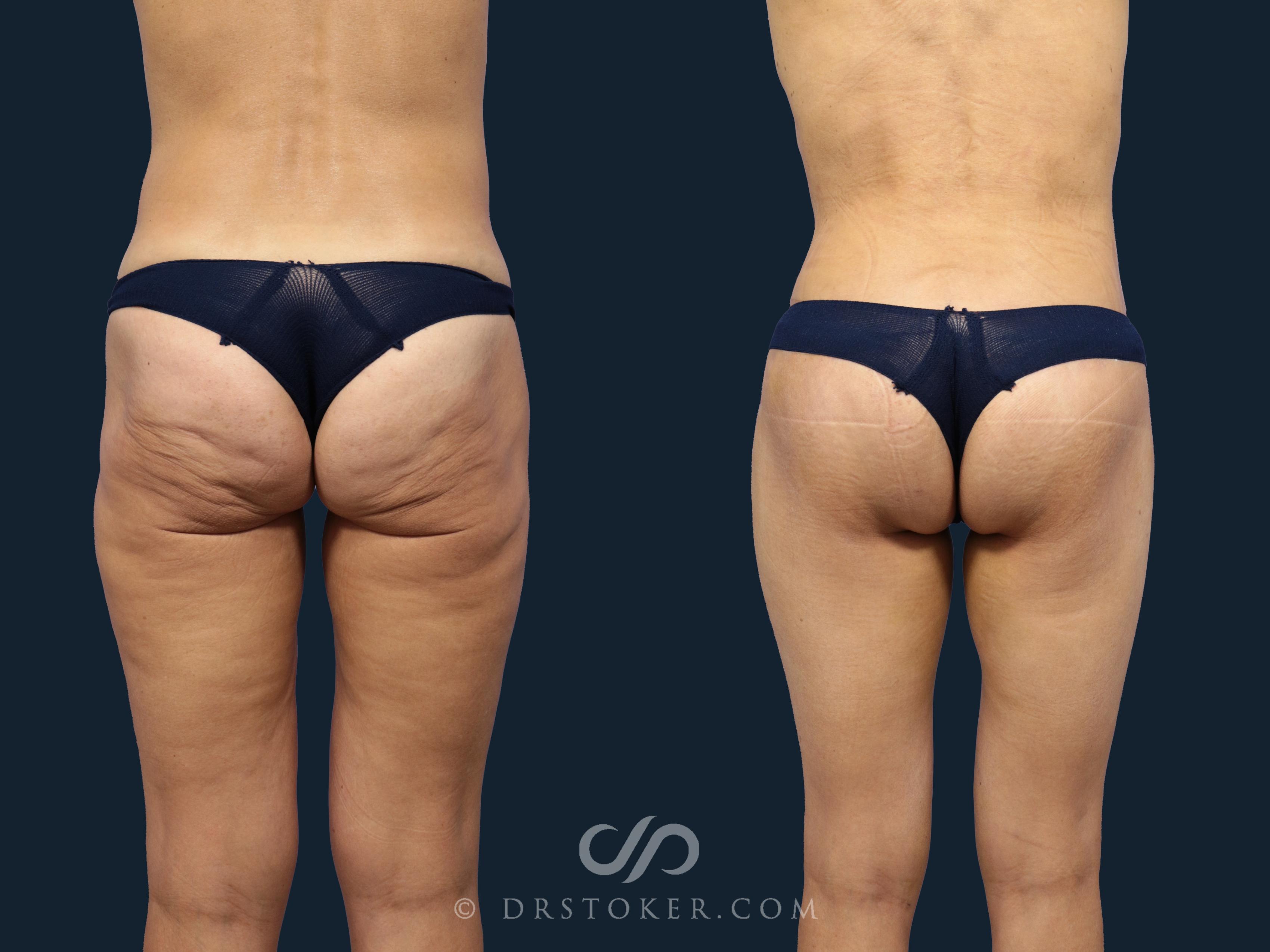 Before & After Bikini Body Lift Case 1712 Back View in Los Angeles, CA