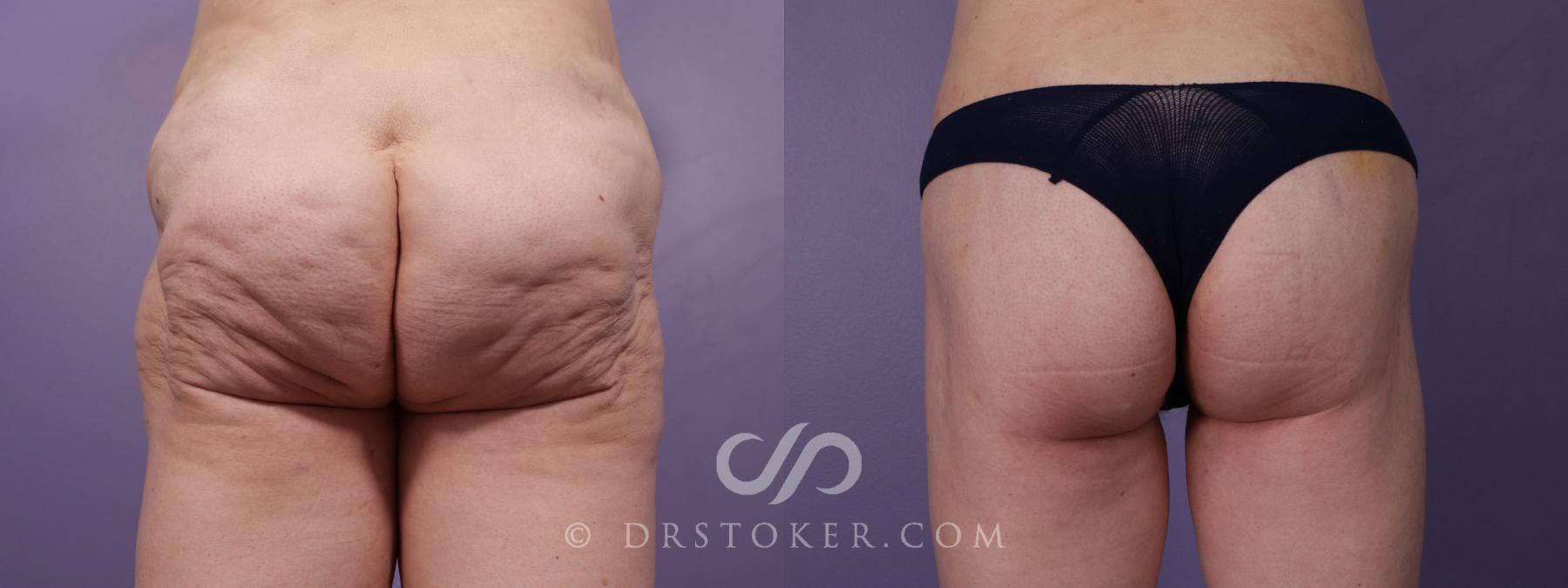 Before & After Thigh lift Case 1828 Back View in Los Angeles, CA