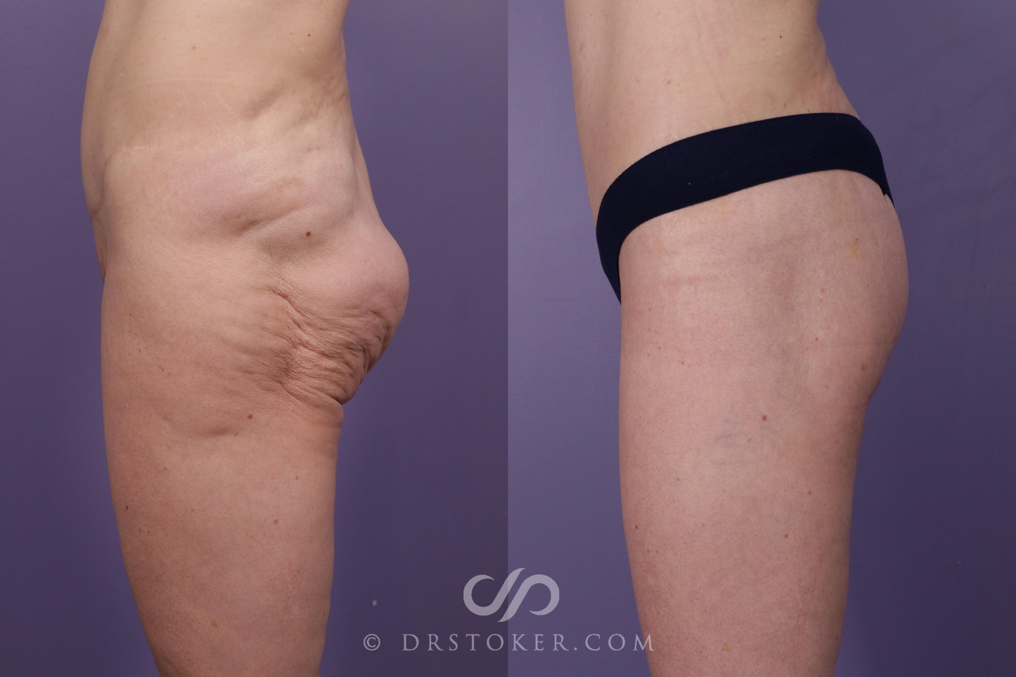 Before & After Thigh lift Case 1830 Left Side View in Los Angeles, CA