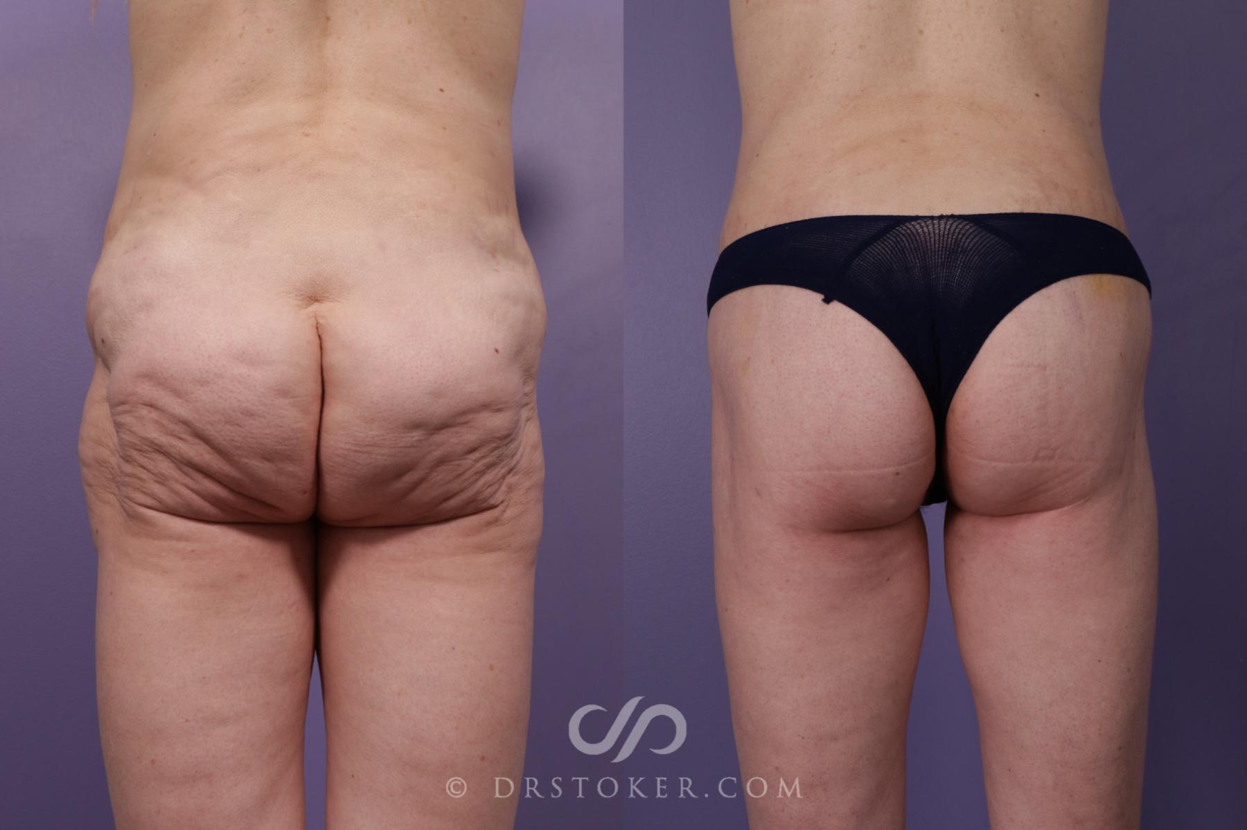 Before & After Thigh lift Case 1831 Back View in Los Angeles, CA